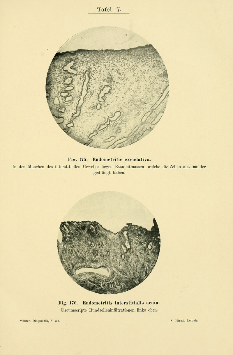 Fig. 175. Endometritis exsudativa. In den Maschen des interstitiellen Gewebes liegen Exsudatmassen, welche die Zellen auseinander gedrängt haben. Fig. 176. Endometritis interstitialis acuta. Circumscripte Rundzelleninfiltrationen links oben.