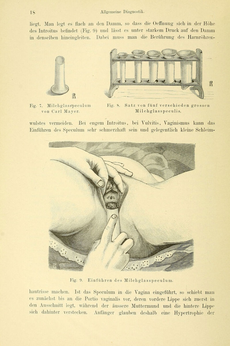 liegt. Man legt es flach an den Damm, so dass die Oeffnung sich in der Höhe des Introitus befindet (Fig. 9) und lässt es unter starkem Druck auf den Damm in denselben hineingleiten. Dabei muss man die Berührung des Harnröhren- Fig. 7. Milchglass-peculum von Carl Mayer. Fig. 8. Satz von fünf verschieden grossen Milcliglasspeculis. Wulstes vermeiden. Bei engem Introitus, bei Vulvitis, Vaginismus kann das Einführen des Speculum sehr schmerzhaft sein und gelegentlich kleine Schleim- Fig. 9. Einführen des Milchglasspeculuni. hautrisse machen. Ist das Speculum in die Vagina eingeführt, so schiebt man es zunächst bis an die Portio vaginahs vor, deren vordere Lippe sich zuerst in den Ausschnitt legt, Avährend der äussere Muttermund und die hintere Lippe sich dahinter verstecken. Anfänger glauben deshalb eine Hypertrophie der