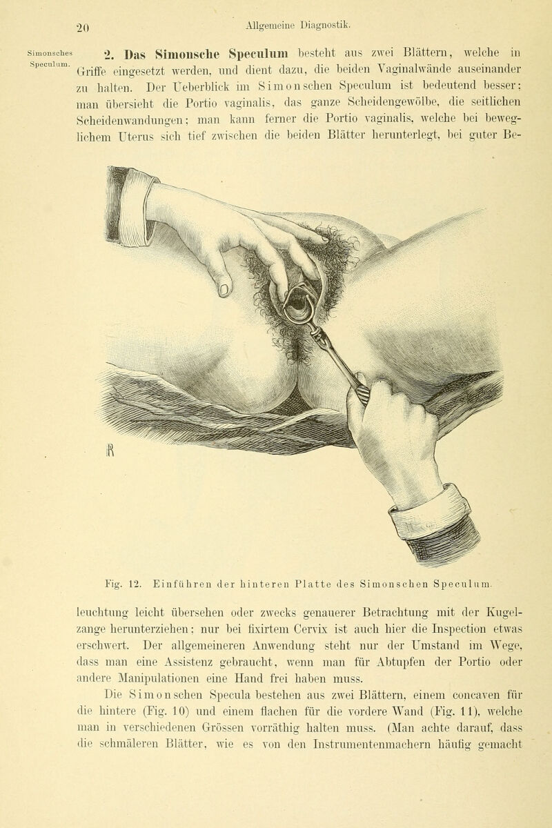 simonsches 2. Drs Siiiionsclie Speciilum besteht aus zwei Blättern, welche in specuium. ^^.^^ eingesetzt werden, nnd dient dazu, die beiden Vaginalwände auseinander zu halten. Der Üeberblick un Simon sehen Specuium ist bedeutend besser: man übersieht die Portio vaginalis, das ganze Scheidengewölbe, die seithchen Scheidenwandungen; man kann femer die Portio vaginalis, welche bei beweg- Kchem Uterus sich tief zwischen die beiden Blätter herunterlegt, bei guter Be- Fig. 12. Einführen der hinteren Platte des Simonschen Specuium. leuchtung leicht übersehen oder zwecks genauerer Betrachtung mit der Kugel- zange herunterziehen; nur bei fixirtem Cervix ist auch hier die Inspection etwas erschwert. Der allgemeineren Anwendung steht nur der Umstand im Wege, dass man eine Assistenz gebraucht, wenn man für Abtupfen der Portio oder andere Manipulationen eine Hand frei haben muss. Die Simonschen Specula bestehen aus zwei Blättern, einem concaven für die hintere (Fig. 10) und einem flachen für die vordere Wand (Fig. 11), welche man in verschiedenen Grössen vorräthig halten muss. (Man achte darauf, dass die schmäleren Blätter, wie es von den Instrumentenmachern häufig gemacht