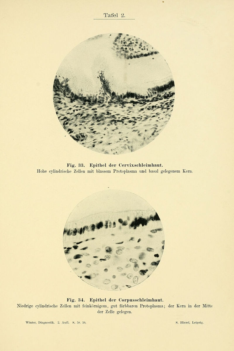 Fig. 33. Epithel der Cervixschleimhaut. Hohe cylindrische Zellen mit blassem Protoplasma und basal gelegenem Kern. 1^ ^ jyfeta^ ^f'HÄ, W^ ^ ^ /:% % m0 m #^ X Fig. 34. Epithel der Corpusschleimhaut. Niedrige cylindrische Zellen mit feinkörnigem, gut färbbaren Protoplasma; der Kern in der Mitte der Zelle gelegen.
