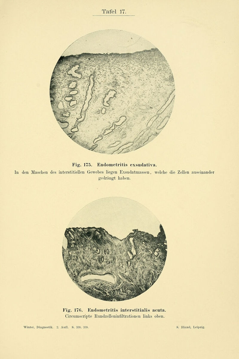 Fig. 175. Endometritis exsudativa. In den Maschen des interstitiellen Gewebes liegen Exsudatmassen, welche die Zellen auseinander e-eclrängt haben. Fig. 176. Endometritis interstitialis acuta. Circumscripte Eundzelleninfiltrationen links oben.