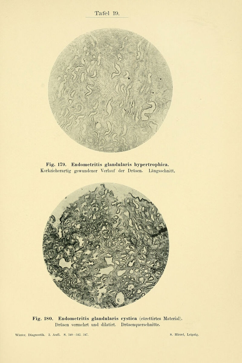 Fig. 179. Endometritis glandularis liypertrophica. Korkzieherartig gewundener Verlauf der Drüsen. Längsschnitt. ' ^ '>:rs;^ Flg. 180. Endometritis glandularis cystica (cürettirtes Material). Drüsen vermehrt und dilatirt. Drüsenquerschnitte.