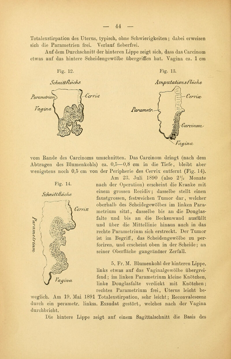 Totalexstirpation des Uterus, typisch, ohne Schwierigkeiten; dabei erweisen sich die Parametrien frei. Verlauf fieberfrei. Auf dem Durchschnitt der hinteren Lippe zeigt sich, dass das Carcinom etwas auf das hintere Scheidengewölbe übergriffen hat. Vagina ca. 1 cra Fig. 12. SctmLtbflciche- Paramjdriuvv Vagi/va, CcrvvX Fig. 13. Arnputodiorts fläche, Cervioc farametr. Fig. 14. SchnMt/läxhc Cerna CUjflJMV vom Rande des Carcinoms umschnitten. Das Carcinom dringt (nach dem Abtragen des Blumenkohls) ca. 0,5—0,8 cm in die Tiefe, bleibt aber wenigstens noch 0,5 cm von der Peripherie des Cervix entfernt (Fig. 14). Am 23. Juli 1890 (also 2J/2 Monate nach der Operation) erscheint die Kranke mit einem grossen Becidiv; dasselbe stellt einen faustgrossen, festweichen Tumor dar, welcher oberhalb des Scheidegewölbes im linken Para- metrium sitzt, dasselbe bis an die Douglas- falte und bis an die Beckenwand ausfüllt und über die Mittellinie hinaus auch in das rechte Parametrium sich erstreckt. Der Tumor ist im Begriff, das Scheidengewölbe zu per- foriren, und erscheint oben in der Scheide; an seiner Oberfläche gangränöser Zerfall. 5. Er. M. Blumenkohl der hinteren Lippe, links etwas auf das Vaginalgewölbe übergrei- fend ; im linken Parametrium kleine Knötchen, linke Douglasfalte verdickt mit Knötchen; rechtes Parametrium frei, Uterus leicht be- weglich. Am 19. Mai 1891 Totalexstirpation, sehr leicht; Reconvalescenz durch ein perametr. linkss. Exsudat gestört, welches nach der Vagina durchbricht. Die hintere Lippe zeigt auf einem Sagittalschnitt die Basis des