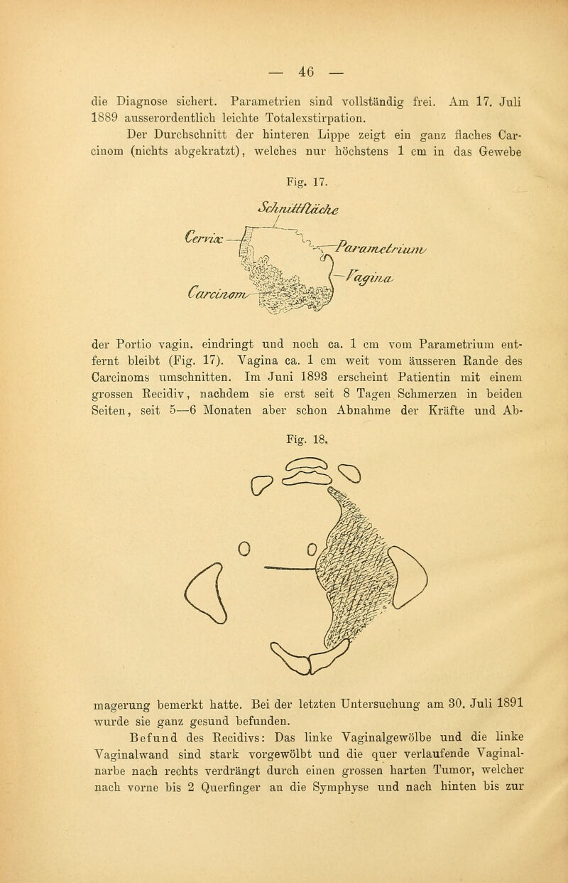 die Diagnose sichert. Parametrien sind vollständig frei. Am 17. Juli 1889 ausserordentlich leichte Totalexstirpation. Der Durchschnitt der hinteren Lippe zeigt ein ganz flaches Car- cinom (nichts abgekratzt), welches nur höchstens 1 cm in das Gewebe Fig. 17. SckmMfläc/ie Q enuc Pareurutriiuiv der Portio vagin. eindringt und noch ca. 1 cm vom Parametrium ent- fernt bleibt (Fig. 17). Vagina ca. 1 cm weit vom äusseren Rande des Carcinoms umschnitten. Im Juni 1893 erscheint Patientin mit einem grossen Eecidiv, nachdem sie erst seit 8 Tagen Schmerzen in beiden Seiten, seit 5—6 Monaten aber schon Abnahme der Kräfte und Ab- magerung bemerkt hatte. Bei der letzten Untersuchung am 30. Juli 1891 wurde sie ganz gesund befunden. Befund des Recidivs: Das linke Vaginalgewölbe und die linke Vaginalwand sind stark vorgewölbt und die quer verlaufende Vaginal- narbe nach rechts verdrängt durch einen grossen harten Tumor, welcher nach vorne bis 2 Querfinger an die Symphyse und nach hinten bis zur