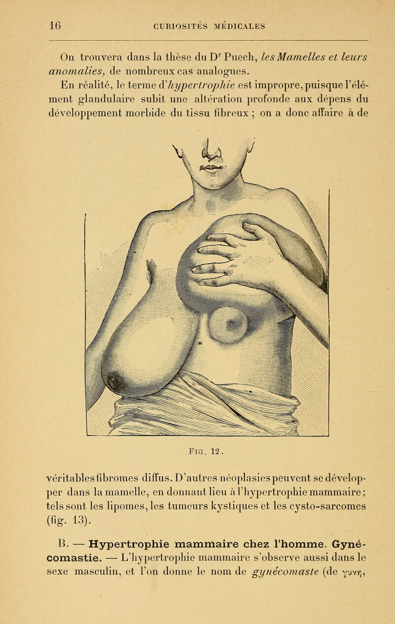 On trouvera dans la thèse du D Puech, les Mamelles et leurs anomalies, de nombreux cas analogues. En réalité, le terme ^hypertrophie est impropre, puisque Félé- ment glandulaire subit une altération profonde aux dépens du développement morbide du tissu fibreux ; on a donc affaire à de FiCr. 12, véritables fibromes diffus. D'autres néoplasies peuvent se dévelop- per dans la mamelle, en donnant lieu à l'hypertrophie mammaire; tels sont les lipomes, les tumeurs kystiques et les cysto-sarcomes (fig. 13). B. — Hypertrophie mammaire chez l'homme. Gyné- comastie. — L'hypertrophie mammaire s'observe aussi dans le sexe masculin, et l'on donne le nom de gynécomaste (de yuvY],