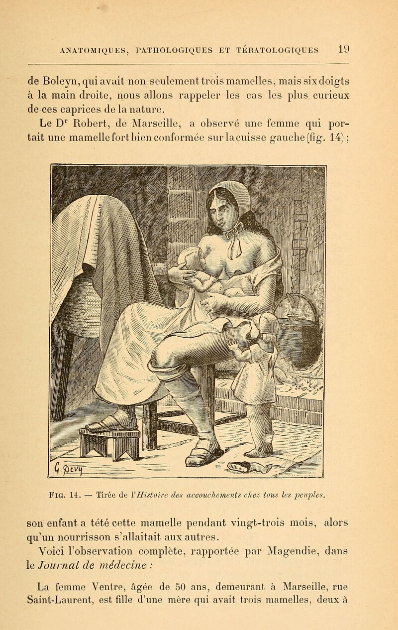 de Boleyn, qui avait non seulement trois mamelles, mais six doigts à la main droite, nous allons rappeler les cas les plus curieux de ces caprices de la nature. Le D* Robert, de Marseille, a observé une femme qui por- tait une mamelle fort bien c(mforraée surlacuisse gauche (fig. 14); FiG. 14. — Tirée de VHistoire des accouchements citez tous les peuples. son enfant a tété cette mamelle pendant vingt-trois mois, alors qu'un nourrisson s'allaitait aux autres. Voici l'observation complète, rapportée par Magendie, dans le Journal de médecine : La femme Ventre, âgée de 50 ans, demeurant à Marseille, rue Saint-Laurent, est fille d'une mère qui avait trois mamelles, deux à