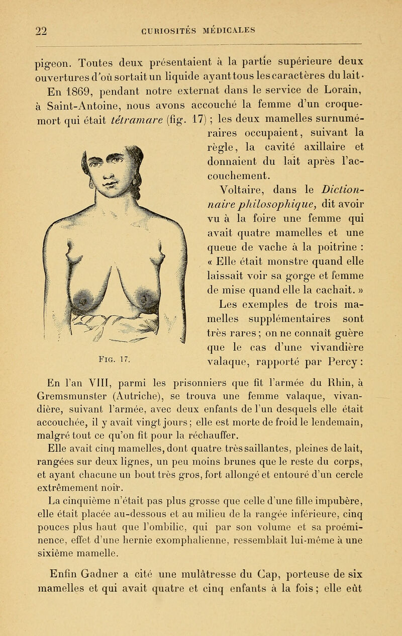 pigeon. Toutes deux présentaient à la partie supérieure deux ouvertures d'où sortait un liquide ayant tous les caractères du lait- En 1869, pendant notre externat dans le service de Lorain, à Saint-Antoine, nous avons accouché la femme d'un croque- mort qui était tétramare (fig. 17) ; les deux mamelles surnumé- raires occupaient, suivant la règle, la cavité axillaire et donnaient du lait après l'ac- couchement. Voltaire, dans le Diction- naire philosophique, dit avoir vu à la foire une femme qui avait quatre mamelles et une queue de vache à la poitrine : « Elle était monstre quand elle laissait voir sa gorge et femme de mise quand elle la cachait. » Les exemples de trois ma- melles supplémentaires sont très rares ; on ne connaît guère que le cas d'une vivandière valaque, rapporté par Percy : Fig. 17. En l'an VIII, parmi les prisonniers que fit l'armée du Rhin, à Gremsmunster (Autriche), se trouva une femme valaque, vivan- dière, suivant l'armée, avec deux enfants de l'un desquels elle était accouchée, il y avait vingt jours; elle est morte de froid le lendemain, malgré tout ce qu'on fit pour la réchauffer. Elle avait cinq mamelles, dont quatre tressaillantes, pleines de lait, rangées sur deux lignes, un peu moins brunes que le reste du corps, et ayant chacune un bout très gros, fort allongé et entouré d'un cercle extrêmement noir. La cinquième n'était pas plus grosse que celle d'une fille impubère, elle était placée au-dessous et au milieu de la rangée inférieure, cinq pouces plus haut que l'ombilic, qui par son volume et sa proémi- nence, effet d'une hernie exomphalienne, ressemblait lui-même à une sixième mamelle. Enfin Gadner a cité une mulâtresse du Cap, porteuse de six mamelles et qui avait quatre et cinq enfants à la fois ; elle eût