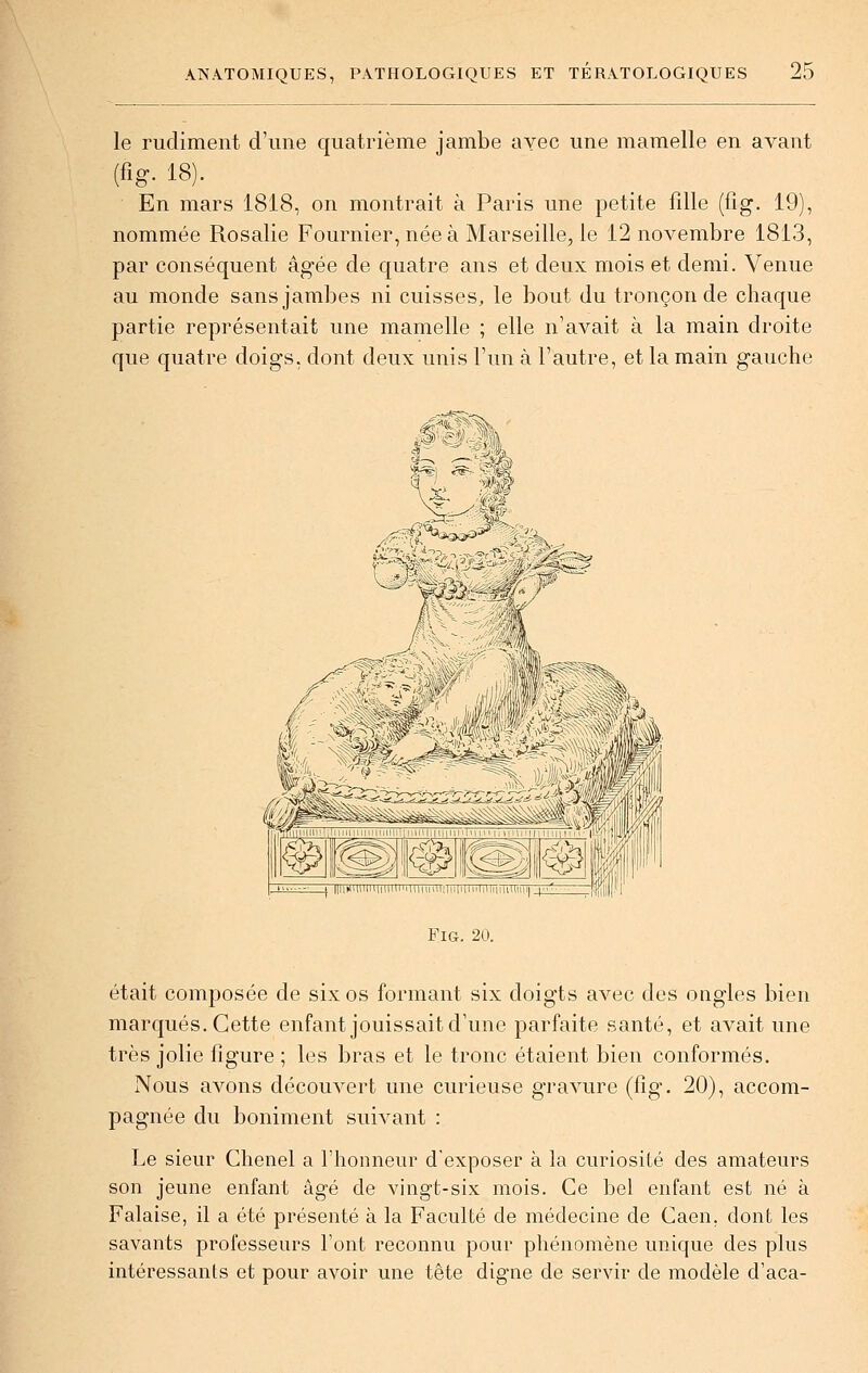 le rudiment d'une quatrième jambe ayec une mamelle en avant (fig. 18). En mars 1818, on montrait à Paris une petite fille (fig. 19), nommée Rosalie Fournier, née à Marseille, le 12 novembre 1813, par conséquent âgée de quatre ans et deux mois et demi. Venue au monde sans jambes ni cuisses, le bout du tronçon de chaque partie représentait une mamelle ; elle n'avait à la main droite que quatre doigs, dont deux unis l'un à l'autre, et la main gauche _j ||liHillilii|iiliiihiUMiiili|ii|i|li.liili|m'niiïiflp Fig. 20. était composée de six os formant six doigts avec des ongles bien marqués. Cette enfant jouissait d'une parfaite santé, et aA^ait une très jolie figure ; les bras et le tronc étaient bien conformés. Nous avons découvert une curieuse gravure (fig. 20), accom- pagnée du boniment suivant : Le sieur Chenel a l'honneur d'exposer à la curiosité des amateurs son jeune enfant âgé de vingt-six mois. Ce bel enfant est né à Falaise, il a été présenté à la Faculté de médecine de Caen. dont les savants professeurs l'ont reconnu pour phénomène unique des plus intéressants et pour avoir une tête digne de servir de modèle d'aca-