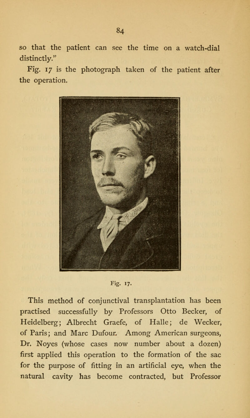 so that the patient can see the time on a watch-dial distinctly. Fig. 17 is the photograph taken of the patient after the operation. Fig. 17. This method of conjunctival transplantation has been practised successfully by Professors Otto Becker, of Heidelberg; Albrecht Graefe, of Halle; de Wecker, of Paris; and Marc Dufour. Among American surgeons, Dr. Noyes (whose cases now number about a dozen) first applied this operation to the formation of the sac for the purpose of fitting in an artificial eye, when the natural cavity has become contracted, but Professor