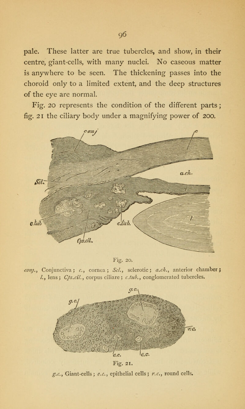 pale. These latter are true tubercles, and show, in their centre, giant-cells, with many nuclei. No caseous matter is anywhere to be seen. The thickening passes into the choroid only to a limited extent, and the deep structures of the eye are normal. Fig. 20 represents the condition of the different parts; fig. 21 the ciliary body under a magnifying power of 200. Fig. 20. conj.y Conjunctiva; c, cornea; Scl., sclerotic; a.ch.^ anterior chamber; /., lens; Cps.ci/., corpus ciliare; c.tub.> conglomerated tubercles. ^r KC. ;'> Icm^SKKm e.c. le*c. Fig. 21. g.c, Giant-cells; e.c, epithelial cells; r.c, round cells.