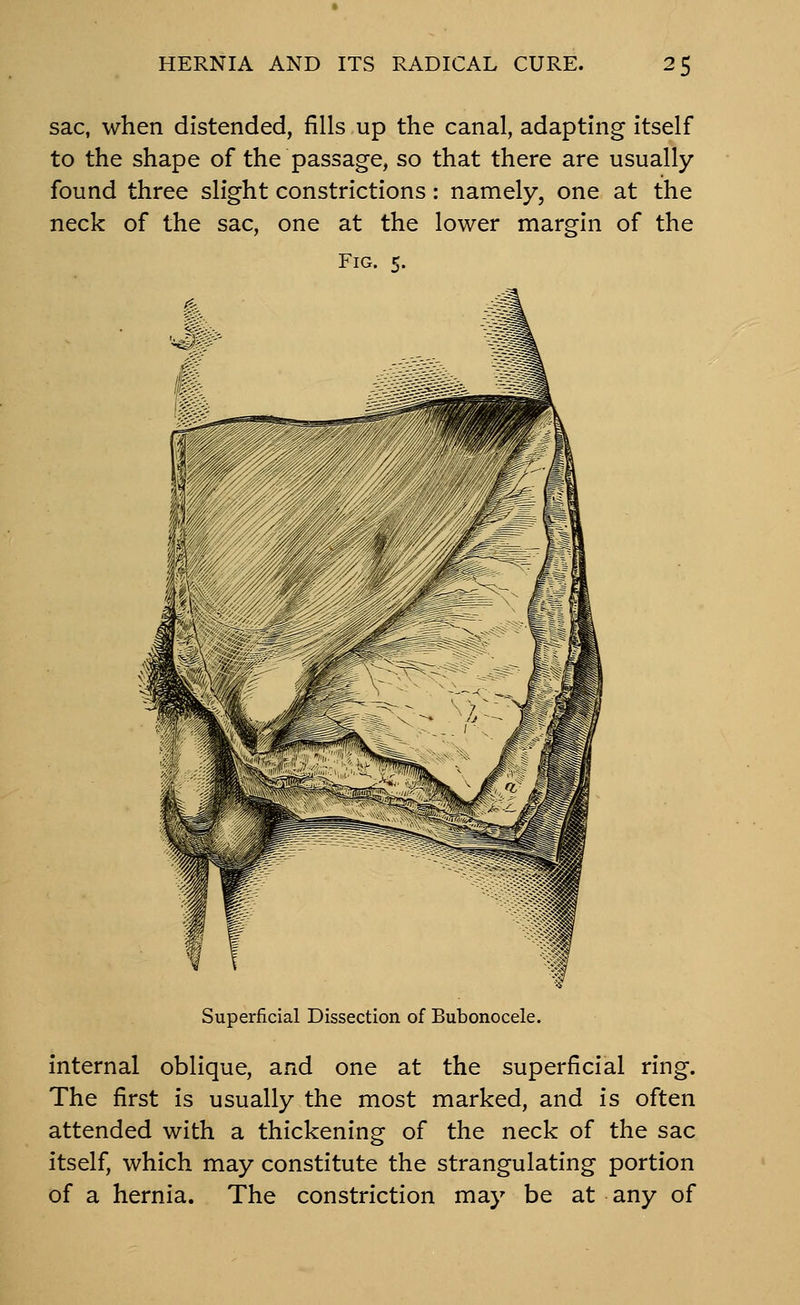 sac, when distended, fills up the canal, adapting itself to the shape of the passage, so that there are usually found three slight constrictions: namely, one at the neck of the sac, one at the lower margin of the Fig. 5. Superficial Dissection of Bubonocele. internal oblique, and one at the superficial ring. The first is usually the most marked, and is often attended with a thickening of the neck of the sac itself, which may constitute the strangulating portion of a hernia. The constriction may be at any of