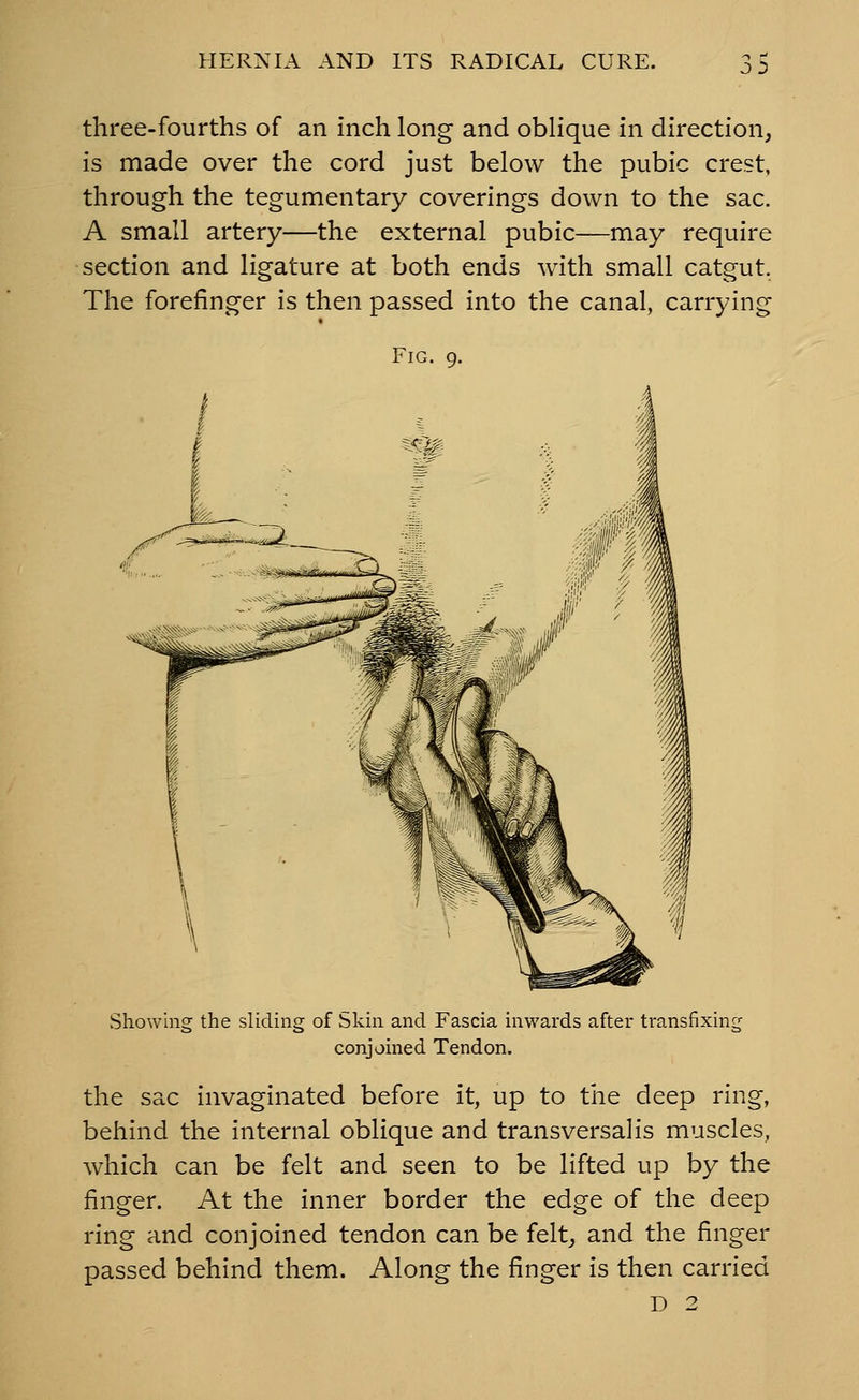 J D three-fourths of an inch long and oblique in direction, is made over the cord just below the pubic crest, through the tegumentary coverings down to the sac. A small artery—the external pubic—may require section and ligature at both ends with small catgut. The forefinger is then passed into the canal, carrying Fig. 9. Showing the sliding of Skin and Fascia inwards after transfixing conjoined Tendon. the sac invaginated before it, up to the deep ring, behind the internal oblique and transversa]is muscles, which can be felt and seen to be lifted up by the finger. At the inner border the edge of the deep ring and conjoined tendon can be felt^ and the finger passed behind them. Along the finger is then carried D 2