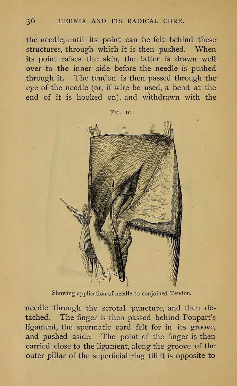 the needle, until its point can be felt behind these structures, through which it is then pushed. When its point raises the skin, the latter is drawn well over to the inner side before the needle is pushed through it. The tendon is then passed through the eye of the needle (or, if wire be used, a bend at the end of it is hooked on), and withdrawn with the Fig. io. Showing application of needle to conjoined Tendon. needle through the scrotal puncture, and then de- tached. The finger is then passed behind Poupart's ligament, the spermatic cord felt for in its groove, and pushed aside. The point of the finger is then carried close to the ligament, along the groove of the outer pillar of the superficial ring till it is opposite to