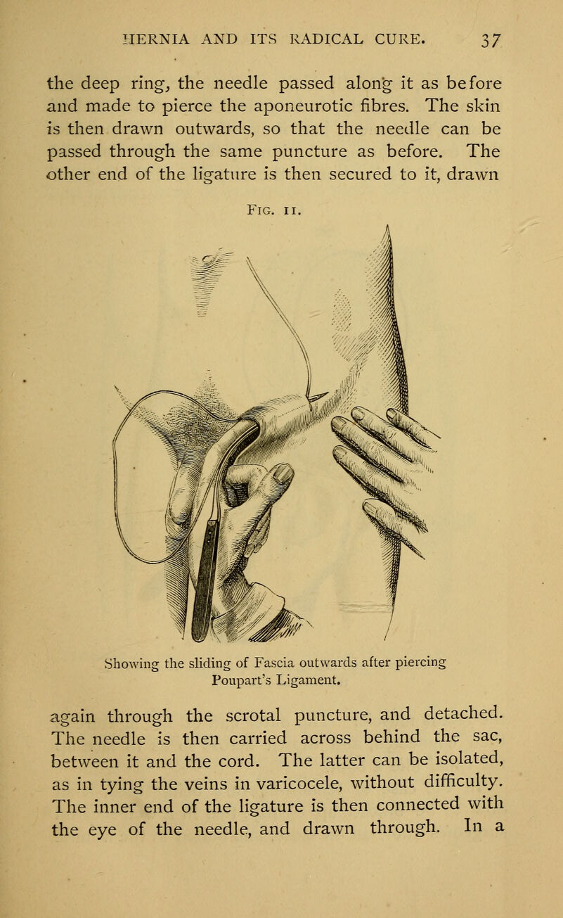 the deep ring,, the needle passed along it as before and made to pierce the aponeurotic fibres. The skin is then drawn outwards, so that the needle can be passed through the same puncture as before. The other end of the ligature is then secured to it, drawn Fig. II. Showing the sliding of Fascia outwards after piercing Poupart's Ligament. again through the scrotal puncture, and detached. The needle is then carried across behind the sac, between it and the cord. The latter can be isolated, as in tying the veins in varicocele, without difficulty. The inner end of the ligature is then connected with the eye of the needle, and drawn through. In a
