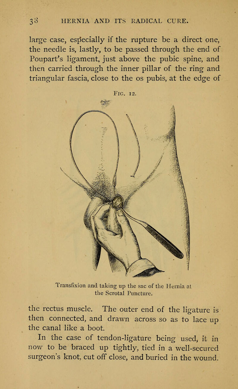 large case, especially if the rupture be a direct one, the needle is, lastly, to be passed through the end of Poupart's ligament, just above the pubic spine, and then carried through the inner pillar of the ring and triangular fascia, close to the os pubis, at the edge of Fig. 12. ^^ Transfixion and taking up the sac of the Hernia at the Scrotal Puncture. the rectus muscle. The outer end of the ligature is then connected, and drawn across so as to lace up the canal like a boot. In the case of tendon-ligature being used, it in now to be braced up tightly, tied in a well-secured surgeon's knot, cut off close, and buried in the wound.