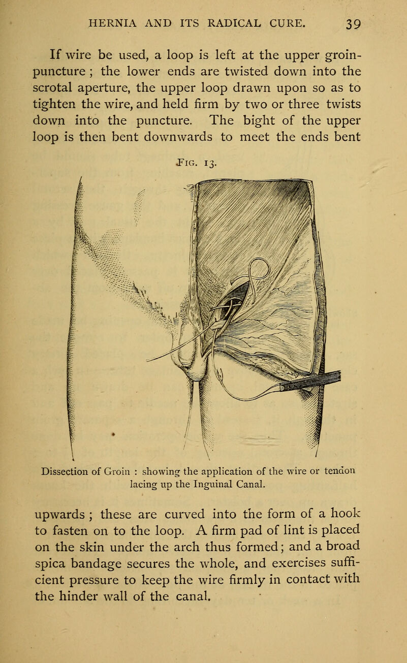 If wire be used, a loop is left at the upper groin- puncture ; the lower ends are twisted down into the scrotal aperture, the upper loop drawn upon so as to tighten the wire, and held firm by two or three twists down into the puncture. The bight of the upper loop is then bent downwards to meet the ends bent J^IG. 13. Dissection of Groin : showing the application of the wire or tendon lacing up the Inguinal Canal. Upwards ; these are curved into the form of a hook to fasten on to the loop. A firm pad of lint is placed on the skin under the arch thus formed; and a broad spica bandage secures the whole, and exercises suffi- cient pressure to keep the wire firmly in contact with the hinder wall of the canal.