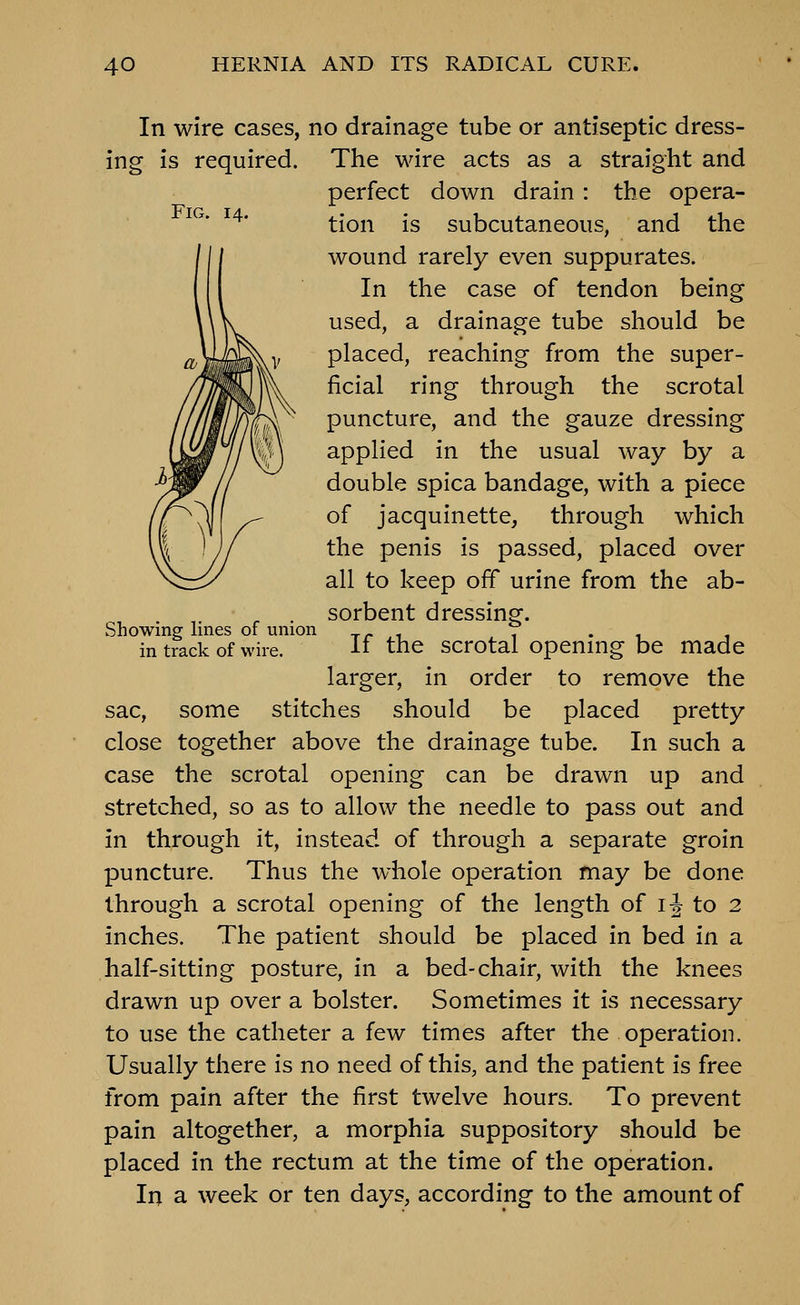 Fig. 14. Showing lines of union in track of wire. In wire cases, no drainage tube or antiseptic dress- ing is required. The wire acts as a straight and perfect down drain : the opera- tion is subcutaneous, and the wound rarely even suppurates. In the case of tendon being used, a drainage tube should be placed, reaching from the super- ficial ring through the scrotal puncture, and the gauze dressing applied in the usual way by a double spica bandage, with a piece of jacquinette, through which the penis is passed, placed over all to keep off urine from the ab- sorbent dressing. If the scrotal opening be made larger, in order to remove the sac, some stitches should be placed pretty close together above the drainage tube. In such a case the scrotal opening can be drawn up and stretched, so as to allow the needle to pass out and in through it, instead of through a separate groin puncture. Thus the whole operation may be done through a scrotal opening of the length of i;| to 2 inches. The patient should be placed in bed in a half-sitting posture, in a bed-chair, with the knees drawn up over a bolster. Sometimes it is necessary to use the catheter a few times after the operation. Usually there is no need of this, and the patient is free from pain after the first twelve hours. To prevent pain altogether, a morphia suppository should be placed in the rectum at the time of the operation. In a week or ten days, according to the amount of
