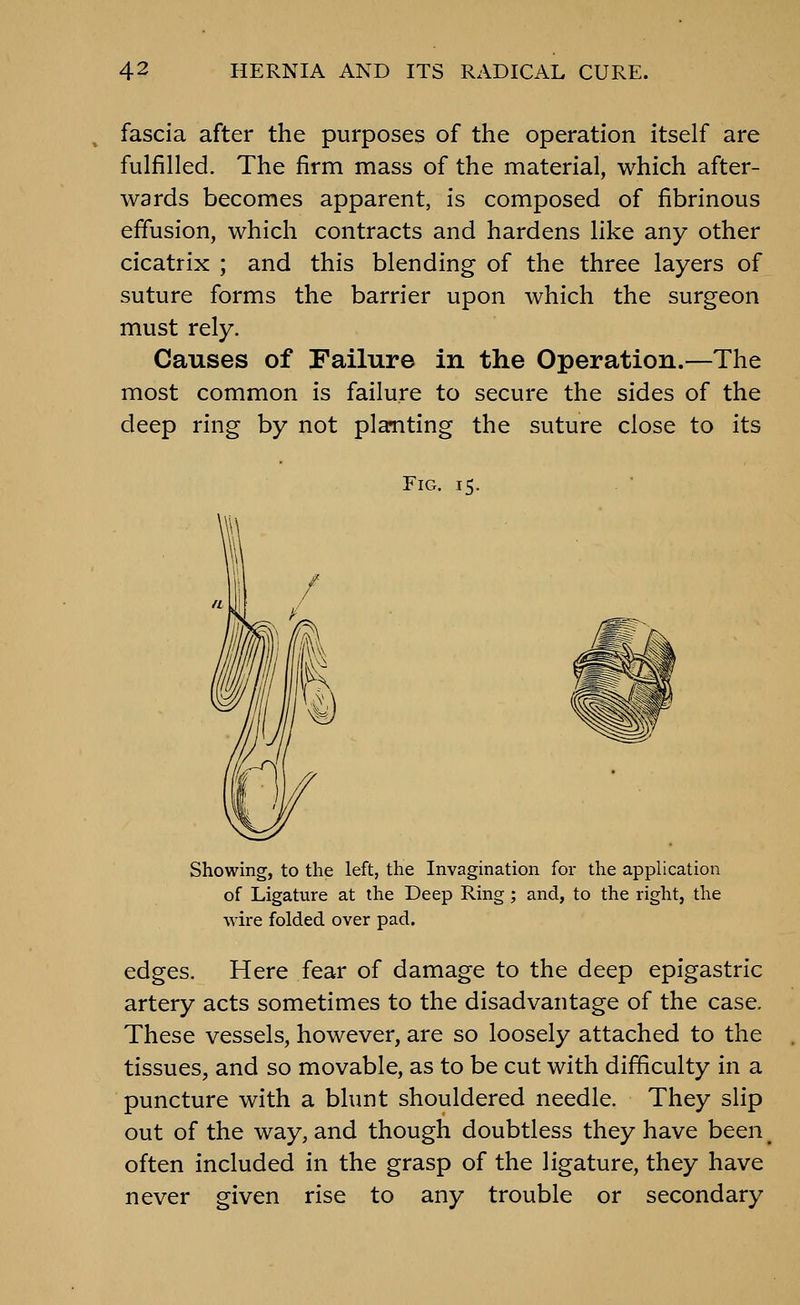 fascia after the purposes of the operation itself are fulfilled. The firm mass of the material, which after- wards becomes apparent, is composed of fibrinous effusion, which contracts and hardens like any other cicatrix ; and this blending of the three layers of suture forms the barrier upon which the surgeon must rely. Causes of Failure in the Operation.—The most common is failure to secure the sides of the deep ring by not planting the suture close to its Fig. 15. Showing, to the left, the Invagination for the application of Ligature at the Deep Ring ; and, to the right, the wire folded over pad. edges. Here fear of damage to the deep epigastric artery acts sometimes to the disadvantage of the case. These vessels, however, are so loosely attached to the tissues, and so movable, as to be cut with difficulty in a puncture with a blunt shouldered needle. They slip out of the way, and though doubtless they have been _ often included in the grasp of the ligature, they have never given rise to any trouble or secondary