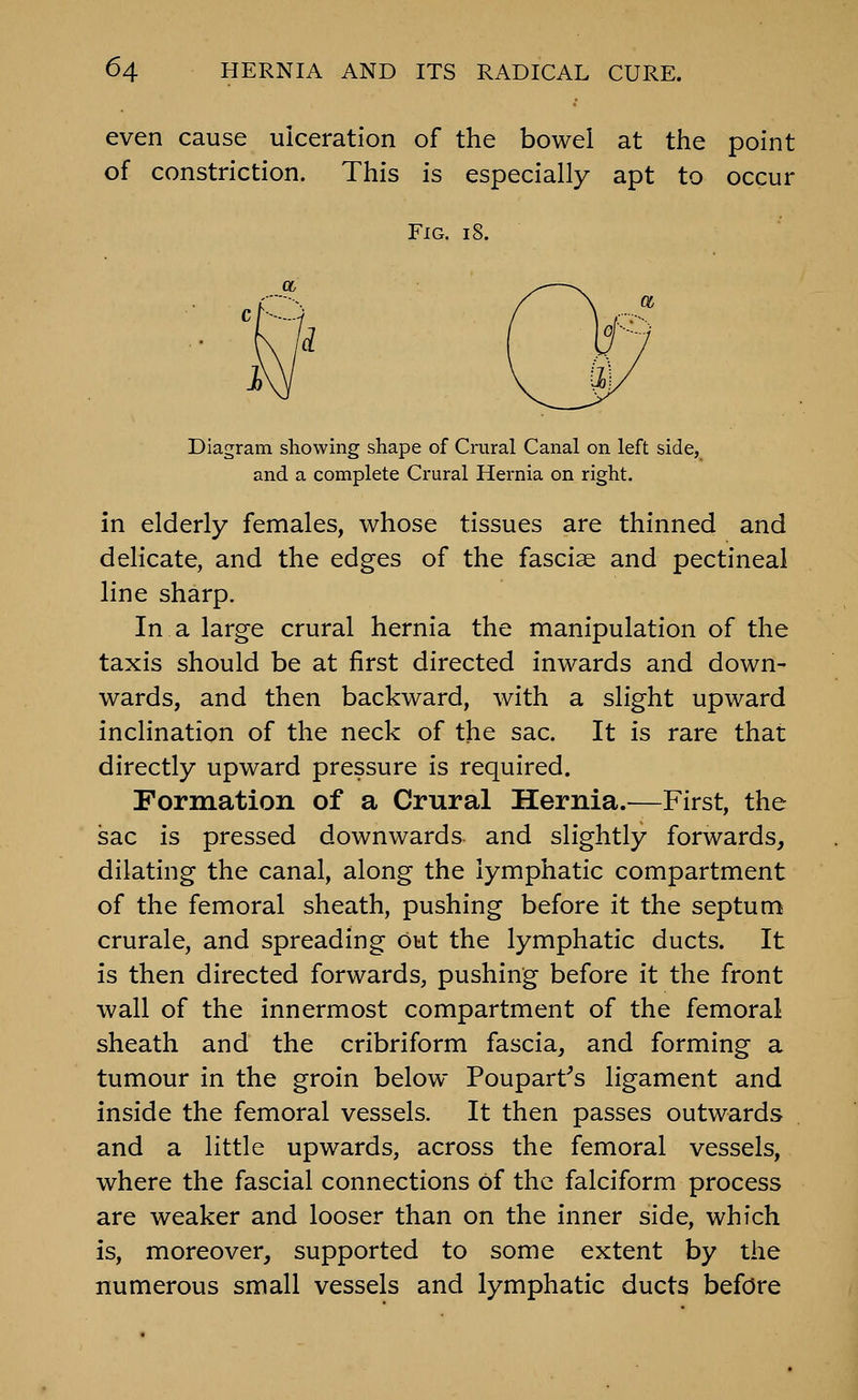 even cause ulceration of the bowel at the point of constriction. This is especially apt to occur Fig. i8. Diagram showing shape of Crural Canal on left side, and a complete Crural Hernia on right. in elderly females, whose tissues are thinned and delicate, and the edges of the fasciae and pectineal line sharp. In a large crural hernia the manipulation of the taxis should be at first directed inwards and down- wards, and then backward, with a slight upward inclination of the neck of the sac. It is rare that directly upward pressure is required. Formation of a Crural Hernia.^—First, the sac is pressed downwards and slightly forwards, dilating the canal, along the lymphatic compartment of the femoral sheath, pushing before it the septum crurale, and spreading out the lymphatic ducts. It is then directed forwards, pushing before it the front wall of the innermost compartment of the femoral sheath and the cribriform fascia, and forming a tumour in the groin below Poupart's ligament and inside the femoral vessels. It then passes outwards and a little upwards, across the femoral vessels, where the fascial connections of the falciform process are weaker and looser than on the inner side, which is, moreover, supported to some extent by the numerous small vessels and lymphatic ducts before