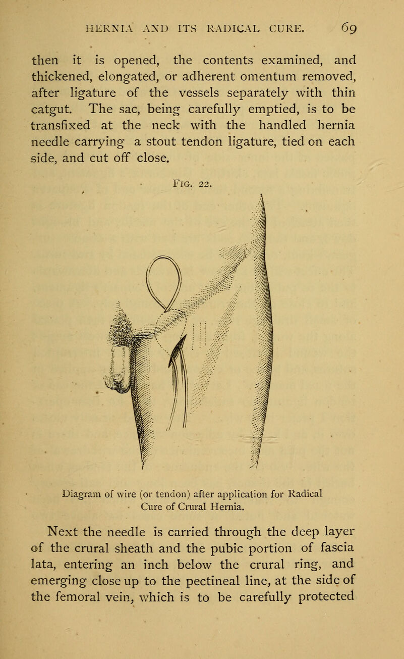 then it is opened, the contents examined, and thickened, elongated, or adherent omentum removed, after ligature of the vessels separately with thin catgut. The sac, being carefully emptied, is to be transfixed at the neck with the handled hernia needle carrying a stout tendon ligature, tied on each side, and cut off close. Fig. 22. Diagram of wire (or tendon) after application for Radical Cure of Crural Hernia. Next the needle is carried through the deep layer of the crural sheath and the pubic portion of fascia lata, entering an inch below the crural ring, and emerging close up to the pectineal line, at the side of the femoral vein, which is to be carefully protected