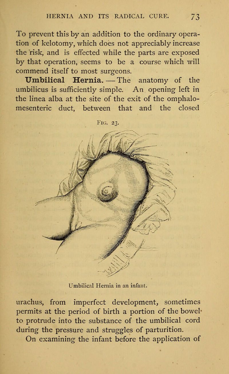 To prevent this by an addition to the ordinary opera- tion of kelotomy, which does not appreciably increase the risk, and is effected while the parts are exposed by that operation, seems to be a course which will commend itself to most surgeons. Umbilical Hernia. — The anatomy of the umbilicus is sufficiently simple. An opening left in the linea alba at the site of the exit of the omphalo- mesenteric duct, between that and the closed Fig. 2.7. Umbilical Hernia in an infant. urachus, from imperfect development, sometimes permits at the period of birth a portion of the bowel- to protrude into the substance of the umbilical cord during the pressure and struggles of parturition. On examining the infant before the application of