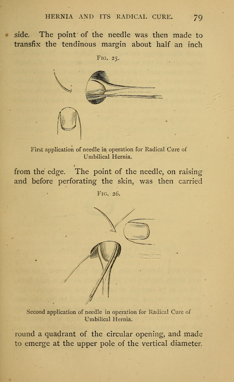 side. The point of the needle was then made to transfix the tendinous margin about half an inch Fig. 2= First application of needle in operation for Radical Cure of Umbilical Hernia. from the' edge. The point of the needle, on raising and before perforating the skin, was then carried Fig. 26. Second application of needle in operation for Radical Cure of Umbilical Hernia. round a quadrant of the circular opening, and made to emerge at the upper pole of the vertical diameter.