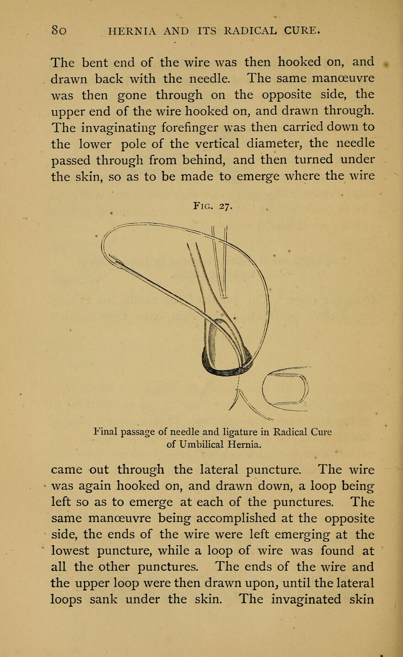 The bent end of the wire was then hooked on, and drawn back with the needle. The same manoeuvre was then gone through on the opposite side, the upper end of the wire hooked on, and drawn through. The invaginating forefinger was then carried down to the lower pole of the vertical diameter, the needle passed through from behind, and then turned under the skin, so as to be made to emerge where the wire Fig. 27. Final passage of needle and ligature in Radical Cure of Umbilical Hernia. came out through the lateral puncture. The wire was again hooked on, and drawn down, a loop being left so as to emerge at each of the punctures. The same manoeuvre being accomplished at the opposite side, the ends of the wire were left emerging at the lowest puncture, while a loop of wire was found at all the other punctures. The ends of the wire and the upper loop were then drawn upon^ until the lateral loops sank under the skin. The invaginated skin