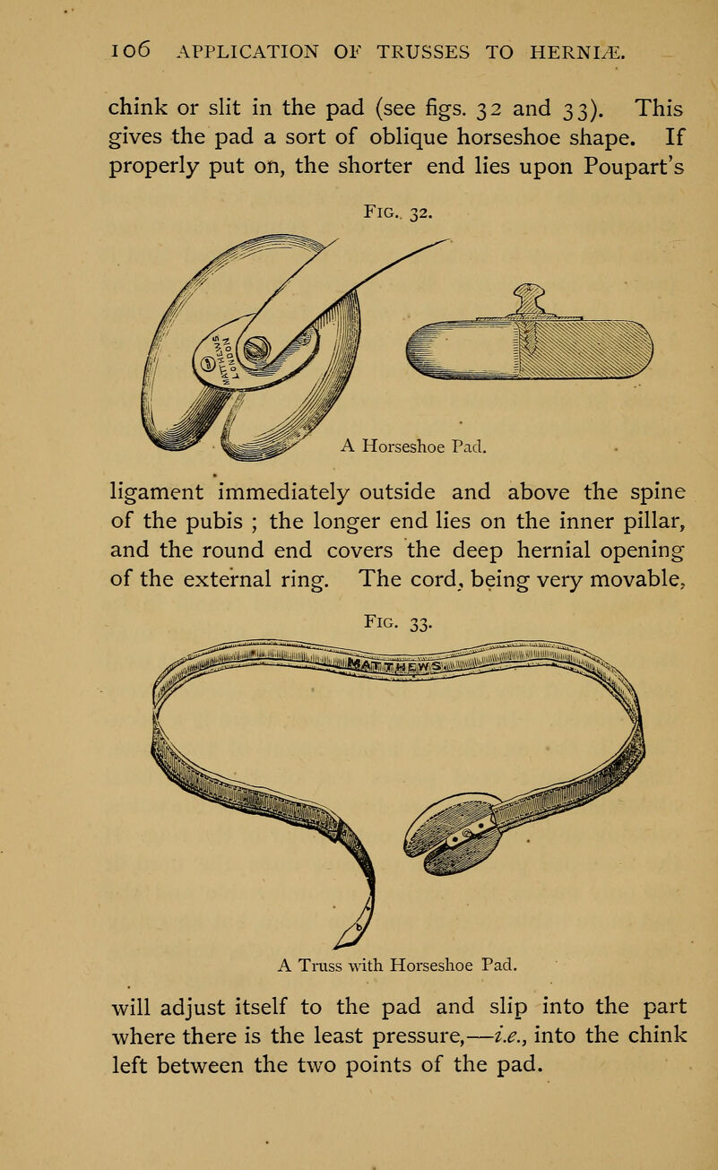 chink or slit in the pad (see figs. 32 and 33). This gives the pad a sort of oblique horseshoe shape. If properly put on, the shorter end lies upon Poupart's Fig.. 32. A Horseshoe Pad. ligament immediately outside and above the spine of the pubis ; the longer end lies on the inner pillar, and the round end covers the deep hernial opening of the external ring. The cord, being very movable. Fig. 33. A Trass with Horseshoe Pad. will adjust itself to the pad and slip into the part where there is the least pressure,—i.e., into the chink left between the two points of the pad.