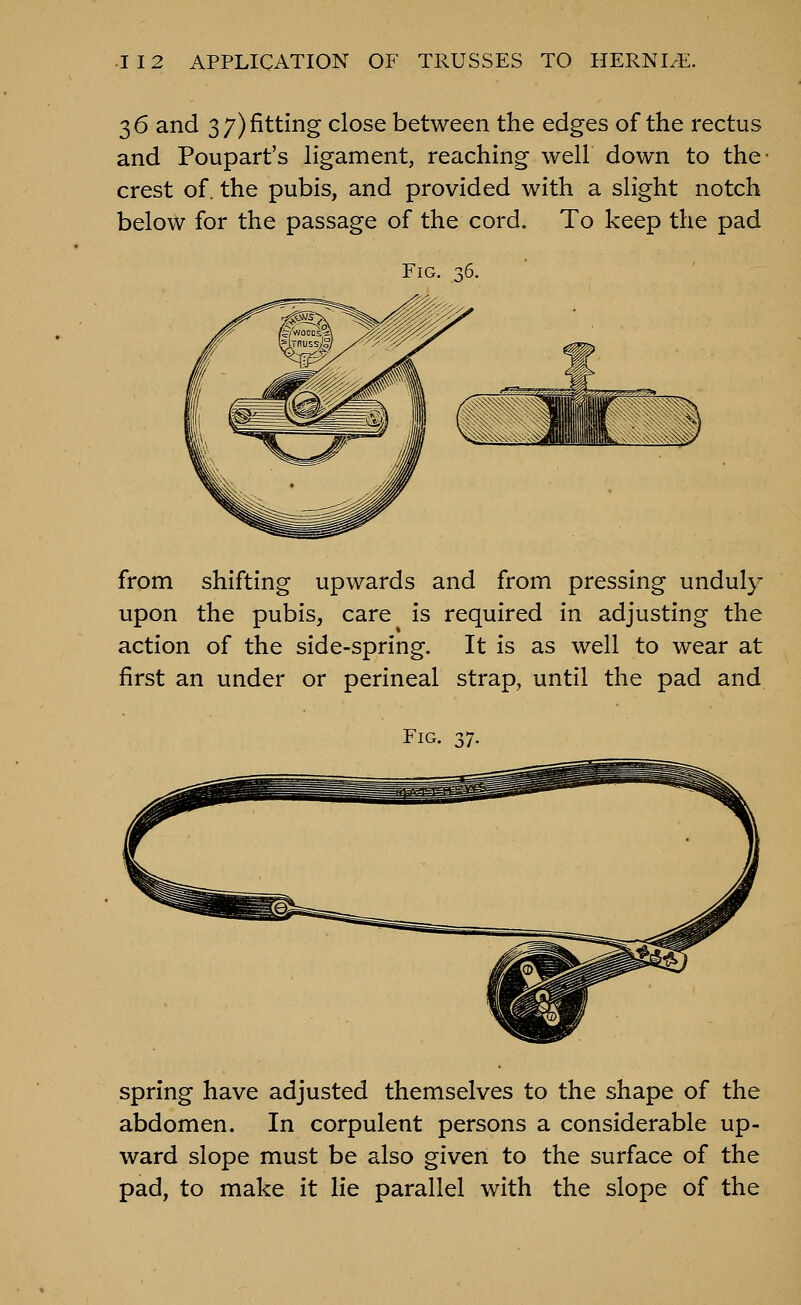 36 and 3 7) fitting close between the edges of the rectus and Poupart's ligament, reaching well down to the crest of. the pubis, and provided with a slight notch beloW for the passage of the cord. To keep the pad Fig. 36. from shifting upwards and from pressing unduly upon the pubis, care is required in adjusting the action of the side-spring. It is as well to wear at first an under or perineal strap, until the pad and Fig spring have adjusted themselves to the shape of the abdomen. In corpulent persons a considerable up- ward slope must be also given to the surface of the pad, to make it lie parallel with the slope of the