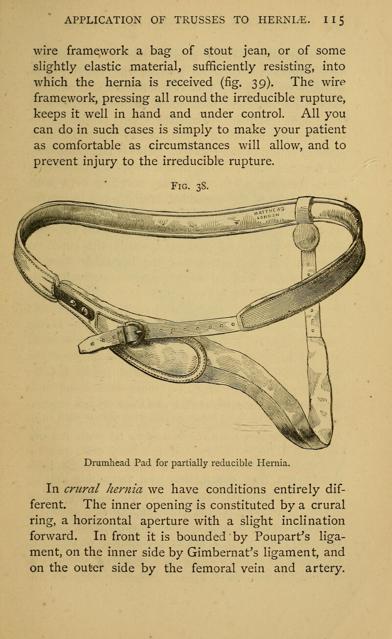 wire framework a bag of stout jean, or of some slightly elastic material, sufficiently resisting, into which the hernia is received (fig. 39). The wire framework, pressing all round the irreducible rupture, keeps it well in hand and under control. All you can do in such cases is simply to make your patient as comfortable as circumstances will allow, and to prevent injury to the irreducible rupture. Fig. 38. Drumhead Pad for partially reducible Hernia. In crural hernia we have conditions entirely dif- ferent. The inner opening is constituted by a crural ring, a horizontal aperture with a slight inclination forward. In front it is bounded by Poupart's liga- ment, on the inner side by Gimbernat^s ligament, and on the outer side by the femoral vein and artery.