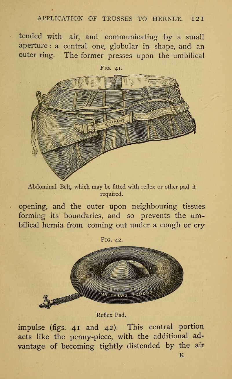 tended with air, and communicating by a small aperture: a central one, globular in shape, and an outer ring. The former presses upon the umbilical Fig. 41. Abdominal Belt, which may be fitted with reflex or other pad it required. opening, and the outer upon neighbouring tissues forming its boundaries, and so prevents the um- bilical herrtia from coming out under a cough or cry Fig. 42. Reflex Pad. impulse (figs. 41 and 42). This central portion acts like the penny-piece, with the additional ad- vantage of becoming tightly distended by the air K