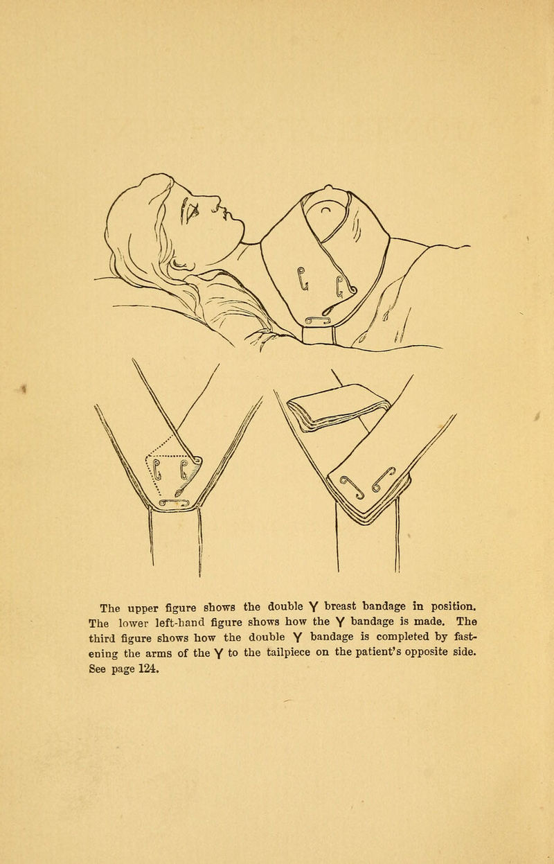The upper figure shows the double Y breast bandage in position. The lower left-hand figure shows how the Y bandage is made. The third figure shows how the double Y bandage is completed by fast- ening the arms of the Y to the tailpiece on the patient's opposite side. See page 124.