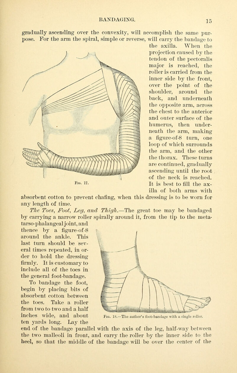 Fig. 17. gradually ascending over the convexity, will accomplish the same pur- pose. For the arm the spiral, simple or reverse, will carry the bandage to the axilla. When the projection caused by the tendon of the pectoralis major is reached, the roller is carried from the inner side by the front, over the point of the shoulder, around the back, and underneath the opposite arm, across the chest to the anterior and outer surface of the humerus, then under- neath the arm, making a figure-of-8 turn, one loop of which surrounds the arm, and the other the thorax. These turns are continued, gradually ascending until the root of the neck is reached. It is best to fill the ax- illa of both arms with absorbent cotton to prevent chafing, when this dressing is to be worn for any length of time. TJie Toes, Foot, Leg, and ThigJi.—The great toe may be bandaged by carrying a narrow roller spirally around it, from the tip to the meta- tarso-phalangeal joint, and thence by a figure-of-8 around the ankle. This last turn should be sev- eral times repeated, in or- der to hold the dressing firmly. It is customary to include all of the toes in the general foot-bandage. To bandage the foot, begin by placing bits of absorbent cotton between the toes. Take a roller from two to two and a half inches wide, and about ten yards long. Lay the end of the bandage parallel with the axis of the leg, half-way between the two malleoli in front, and carry the roller by the inner side to the heel, so that the middle of the bandage will be over the center of the Fig. 18.—The author's foot-bandatfe with a single roller.