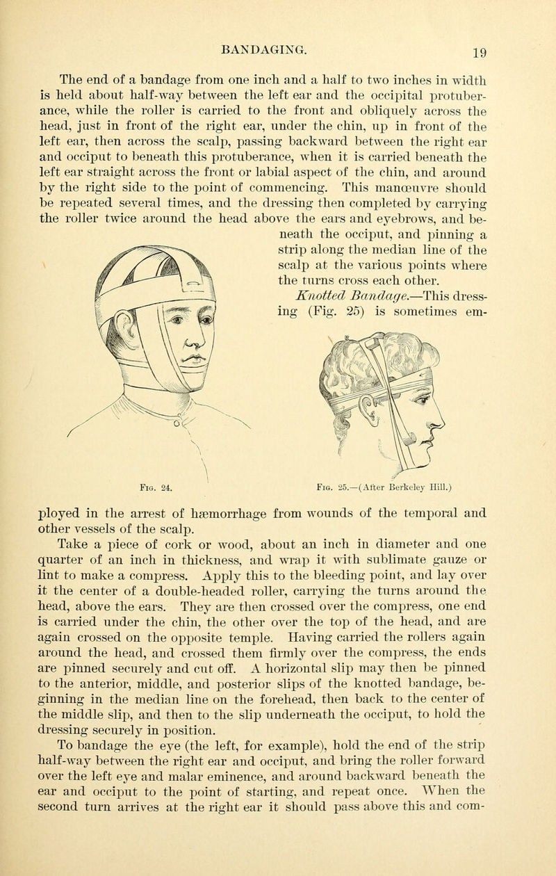 The end of a bandage from one inch, and a half to two inches in width is held about half-way between the left ear and the occipital protuber- ance, while the roller is carried to the front and obliquely across the head, just in front of the right ear, under the chin, up in front of the left ear, then across the scalp, passing backward between the right ear and occiput to beneath this protuberance, when it is carried beneath the left ear straight across the front or labial aspect of the chin, and around by the right side to the point of commencing. This manoeuvre should be repeated several times, and the dressing then completed by carrying the roller twice around the head above the ears and eyebrows, and be- neath the occiput, and pinning a strip along the median line of the scalp at the various points where the turns cross each other. Knotted Bandage.—This dress- ing (Fig. 25) is sometimes em- FiG. 24. Fig. 25.—(After Berkeley Hill.) ployed in the arrest of haemorrhage from wounds of the temporal and other vessels of the scalp. Take a x)iece of cork or wood, about an inch in diameter and one quarter of an inch in thickness, and wrap it with sublimate gauze or lint to make a compress. Apply this to the bleeding point, and lay over it the center of a double-headed roller, carrying the turns around the head, above the ears. They are then crossed over the compress, one end is carried under the chin, the other over the top of the head, and are again crossed on the opposite temple. Having carried the rollers again around the head, and crossed them firmly over the compress, the ends are pinned securely and cut off. A horizontal slip may then be pinned to the anterior, middle, and posterior slips of the knotted bandage, be- ginning in the median line on the forehead, then back to the center of the middle slip, and then to the slip underneath the occiput, to hold the dressing securely in position. To bandage the eye (the left, for example), hold the end of the strip half-way between the right ear and occiput, and bring the roller forward over the left eye and malar eminence, and around backward beneath the ear and occiput to the point of starting, and repeat once. When the second turn arrives at the right ear it should pass above this and com-