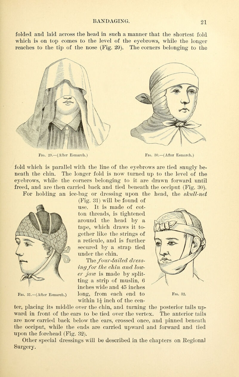 folded and laid across the head in such a manner that the shortest fold which is on top comes to the level of the eyebrows, while the longer reaches to the tip of the nose (Fig. 29). The corners belonging to the >^^ li|«lll\Vi\\ Fm. 29.—(After Esmarch.) Fig. 30.—(After Esmarch.) fold which is parallel with the line of the eyebrows are tied snngly be- neath the chin. The longer fold is now turned up to the level of the eyebrows, while the corners belonging to it are drawn forward until freed, and are then carried back and tied beneath the occiput (Fig. 30). For holding an ice-bag or dressing upon the head, the skull-net (Fig. 31) will be found of use. It is made of cot- ton threads, is tightened around the head by a tape, which draws it to- gether like the strings of a reticule, and is further secured by a strap tied under the chin. The four-tailed dress- ing for the chin and low- er jaw is made by split- ting a strip of muslin, 6 inches wide and 45 inches within li inch of the cen- ter, placing its middle over the chin, and turning the posterior tails up- ward in front of the ears to be tied over the vertex. The anterior tails are now carried back below the ears, crossed once, and pinned beneath the occiput, while the ends are carried upward and forward and tied upon the forehead (Fig. 32). Other special dressings will be described in the chapters on Regional Surgery. Fig. 31.—(After Esmarch.)