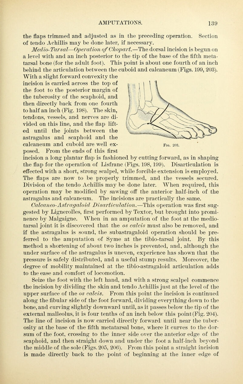 the flaps trimmed and adjusted as in the preceding operation. Section of tendo A chillis may be done later, if necessary. Medio-Tarsal—Operation of CJiopart.—The dorsal incision is begun on a level with and an inch posterior to the tip of the base of the fifth meta- tarsal bone (for the adult foot). This point is about one fourth of an inch behind the articulation between the cuboid and calcaneum (Figs. 199, 203). With a slight forward convexity the incision is carried across the top of ^ > i \ | the foot to the posterior margin of I ' '■ \ \ the tuberosity of the scaphoid, and ' ; ] \^^^ then directly back from one fourth , - '- T'^- to half an inch (Fig. 198). The skin, ^ / ■; ' // --^/K tendons, vessels, and nerves are di- *'■- ix ^~--'^'-'^'~'~-~^^^'>-^ vided on this line, and the flap lift- ^ \ -. /••''^■^^v/;x- '■--? ■■^ <~^^^i^. ed until the joints between the '^...^^^...^^^^^^■■-■-^►^^ astragalus and scaphoid and the ^^^^^^^^^^..S-^ calcaneum and cuboid are well ex- Fig. 203. posed. From the ends of this first incision a long plantar flap is fashioned by cutting forward, as in shaping the flap for the operation of Lisfranc (Figs. 198,199). Disarticulation is effected with a short, strong scalpel, while forcible extension is employed. The flaps are now to be properly trimmed, and the vessels secured. Division of the tendo Achillis may be done later. When required, this operation may be modified by sawing off the anterior half-inch of the astragalus and calcaneum. The incisions are practically the same. Calcaneo-Astragaloid Disarticulation.—This operation was first sug- gested by Lignerolles, first performed by Textor, but brought into promi- nence by Malgaigne. When in an amputation of the foot at the medio- tarsal joint it is discovered that the os calcis must also be removed, and if the astragalus is sound, the subastragaloid operation should be pre- ferred to the amputation of Syme at the tibio-tarsal joint. By this method a shortening of about two inches is prevented, and, although the under surface of the astragalus is uneven, experience has shown that the pressure is safely distributed, and a useful stump results. Moreover, the degree of mobility maintained at the tibio-astragaloid articulation adds to the ease and comfort of locomotion. Seize the foot with the left hand, and with a strong scalpel commence the incision by dividing the skin and tendo Achillis just at the level of the upper surface of the os calcis. From this point the incision is continued along the fibular side of the foot forward, dividing everything down to the bone, and curving slightly downward until, as it passes below the tip of the external malleolus, it is four tenths of an inch below this point (Fig. 204). The line of incision is now carried directly forward until near the tuber- osity at the base of the fifth metatarsal bone, where it curves to the dor- sum of the foot, crossing to the inner side over the anterior edge of the scaphoid, and then straight down and under the foot a half-inch beyond the middle of the sole (Figs. 205, 206). From this point a straight incision is made directly back to the point of beginning at the inner edge of
