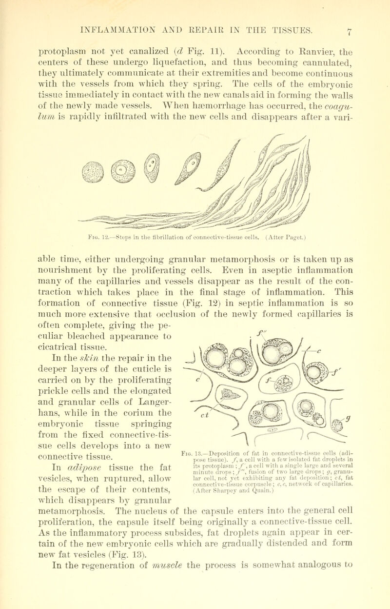 protoplasm not yet canalized (d Fig. 11). According to Ranvier, the centers of these undergo liquefaction, and thus becoming cannulated, they ultimately communicate at their extremities and become continuous with the vessels from which they spring. The cells of the embryonic tissue immediately in contact with the new canals aid in forming the walls of the newly made vessels. When haemorrhage has occurred, the coagu- lurn is rapidly infiltrated with the new cells and disappears after a vari- Fig. 12.—Steps in the fibrillation of connective-tissue cells. (After Paget.) able time, either undergoing granular metamorphosis or is taken up as nourishment by the prolif era ting cells. Even in aseptic inflammation many of the capillaries and vessels disappear as the result of the con- traction which takes place in the final stage of inflammation. This formation of connective tissue (Fig. 12) in septic inflammation is so much more extensive that occlusion of the newly formed capillaries is often complete, giving the pe- culiar bleached appearance to cicatrical tissue. In the skin the repair in the deeper layers of the cuticle is carried on by the proliferating prickle cells and the elongated and granular cells of Langer- hans, while in the corium the embryonic tissue springing from the fixed connective-tis- sue cells develops into a new connective tissue. In adipose tissue the fat vesicles, when ruptured, allow the escape of their contents, which disappears by granular metamorphosis. The nucleus of the capsule enters into the general cell proliferation, the capsule itself being originally a connective-tissue cell. As the inflammatory process subsides, fat droplets again appear in cer- tain of the new embryonic cells which are gradually distended and form new fat vesicles (Fig. 13). In the regeneration of muscle the process is somewhat analogous to Fig. 13.—Deposition of fat in connective-tissue cells (adi- pose tissue). /, a cell with a few isolated fat droplets in its protoplasm ; /', a cell with a single large and several minute drops ; /, fusion of two large drops; g, granu- lar cell, not yet exhibiting any fat deposition; ct, fat connective-tissue corpuscle; c, e, network of capillaries. (After Sharpey and Quain.)