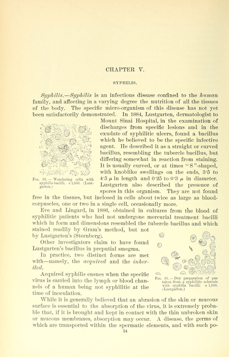 CHAPTER V. SYPHILIS. Syphilis.—Syphilis is an infectious disease confined to the human family, and affecting in a varying degree the nutrition of all the tissues of the body. The specific micro-organism of this disease has not yet been satisfactorily demonstrated. In 1884, Lustgarten, dermatologist to Mount Sinai Hospital, in the examination of <'.'@$:]^C'%.'.v-^;'■■&?&.- discharges from specific lesions and in the - yf_ ,-- } 1'i-'' exudate of syphilitic ulcers, found a bacillus ^'gS.—; ''■■■■■••{$%% -■%*$.'r which he believed to be the specific infective >-^'^'^:^:^^:;vv:;;'^^.^ agent. He described it as a straight or curved >^ v'' ^v^> ^*^ bacillus, resembling the tubercle bacillus, but *■- - _*' \ differing somewhat in reaction from staining. •#:r;;;'.■; y^,. 'Jt>^lp\ It is usually curved, or at times  S -shaped, h?'-^:-c?V< ^;^ £^e with knoblike swellings on the ends, 3*5 to Fig. 55. — Wandering cells with 4*5 /* in length and 0*25 to 0*3 /i in diameter. gffii)bacilli xl,05°- (Lust Lustgarten also described the presence of spores in this organism. They are not found free in the tissues, but inclosed in cells about twice as large as blood- corpuscles, one or two in a single cell, occasionally more. Eve and Lingard, in 1886, obtained in cultures from the blood of syphilitic patients who had not undergone mercurial treatment bacilli which in form and dimensions resembled the tubercle bacillus and which stained readily by Gram's method, but not ; by Lustgarten's (Sternberg). © /^ Cf)n Other investigators claim to have found ^ ^ ^J /? Lustgarten's bacillus in preputial smegma. V> r\ In practice, two distinct forms are met @^ ns C\\ with—namely, the acquired and the inher- C;V; ^~ f-> 5V?r^.g ited. xr^y C^ ,\- ■'-,> '\vi Acquired syphilis ensues when the specific ^ ^ ^l ■ ->~>; virus is carried into the lymph or blood chan- Fl%akerTfSm aPsyPPhmtic sclerous nels of a human being not syphilitic at the J^tSS baciUL * 1,05°' time of inoculation. While it is generally believed that an abrasion of the skin or mucous surface is essential to the absorption of the virus, it is extremely proba- ble that, if it is brought and kept in contact with the thin unbroken skin or mucous membranes, absorption may occur. A disease, the germs of which are transported within the spermatic elements, and with such po-