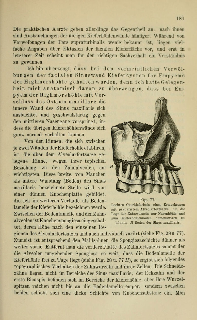 Die praktischen Aerzte geben allerdings das Gegentheil an; nach ihnen sind Ausbauchungen der übrigen Kieferhöhlenwände häufiger. Während von Vorwölbungen der Pars supraturbinalis wenig bekannt ist, liegen viel- fache Angaben über Ektasien der facialen Kieferfläche vor. und erst in letzterer Zeit scheint man für den richtigen Sachverhalt ein Verständnis zu gewinnen. Ich bin überzeugt, dass bei den vermeintlichen Vorwöl- bungen der facialen Sinuswand Kiefercysten für Empyeme der Highmorshöhle gehalten wurden, denn ich hatte Gelegen- heit, mich anatomisch davon zu überzeugen, dass bei Em- pyem der Highmorshöhle mit Ver- schluss desOstium maxillare die innere Wand des Sinus maxillaris sich ausbuchtet und geschwulstartig gegen den mittleren Nasengang vorspringt, in- dess die übrigen Kieferhöhlenwände sich ganz normal verhalten können. Von den Rinnen, die sich zwischen je zwei Wänden der Kieferhöhle etabliren, ist die über dem Alveolarfortsatze ge- legene Rinne, wegen ihrer topischen Beziehung zu den Zahnalveolen, am wichtigsten. Diese breite, von Manchen als untere Wandung (Boden) des Sinus maxillaris bezeichnete Stelle wird von einer dünnen Knochenplatte gebildet, die ich im weiteren Verlaufe als Boden- lamelle der Kieferhöhle bezeichnen werde. Zwischen der Bodenlamelle unddenZahn- alveolen istKnochenspongiosa eingeschal- tet, deren Höhe nach den einzelnen Re- gionen des Alveolarfortsatzes und auch individuell variirt (siehe Fig. 28u. 77). Zumeist ist entsprechend den Malüzähnen die Spongiosaschichte dünner als weiter vorne. Entfernt man die vordere Platte des Zahnfortsatzes sammt der die Alveolen umgebenden Spongiosa so weit, dass die Bodenlamelle der Kieferhöhle frei zu Tage liegt (siehe Fig. 28 u. 77 H), so ergibt sich folgendes topographisches Verhalten der Zahnwurzeln und ihrer Zellen: Die Schneide- zähne liegen nicht im Bereiche des Sinus maxillaris; der Eckzahn und der erste Bicuspis befinden sich im Bereiche der Kieferhöhle, aber ihre Wurzel- spitzen reichen nicht bis an die Bodenlamelle empor, sondern zwischen beiden schiebt sich eine dicke Schichte von Knochensubstanz ein. Man Fig. 77. Hechtes Oberkieferbein eines Erwachsenen mit präparirtem Alveolarfortsatze, um die Lage der Zahnwurzeln zur üsasenhöhle und zum Kieferhöhlenboden demonstriren zu können. H Boden des Sinus maxillaris.
