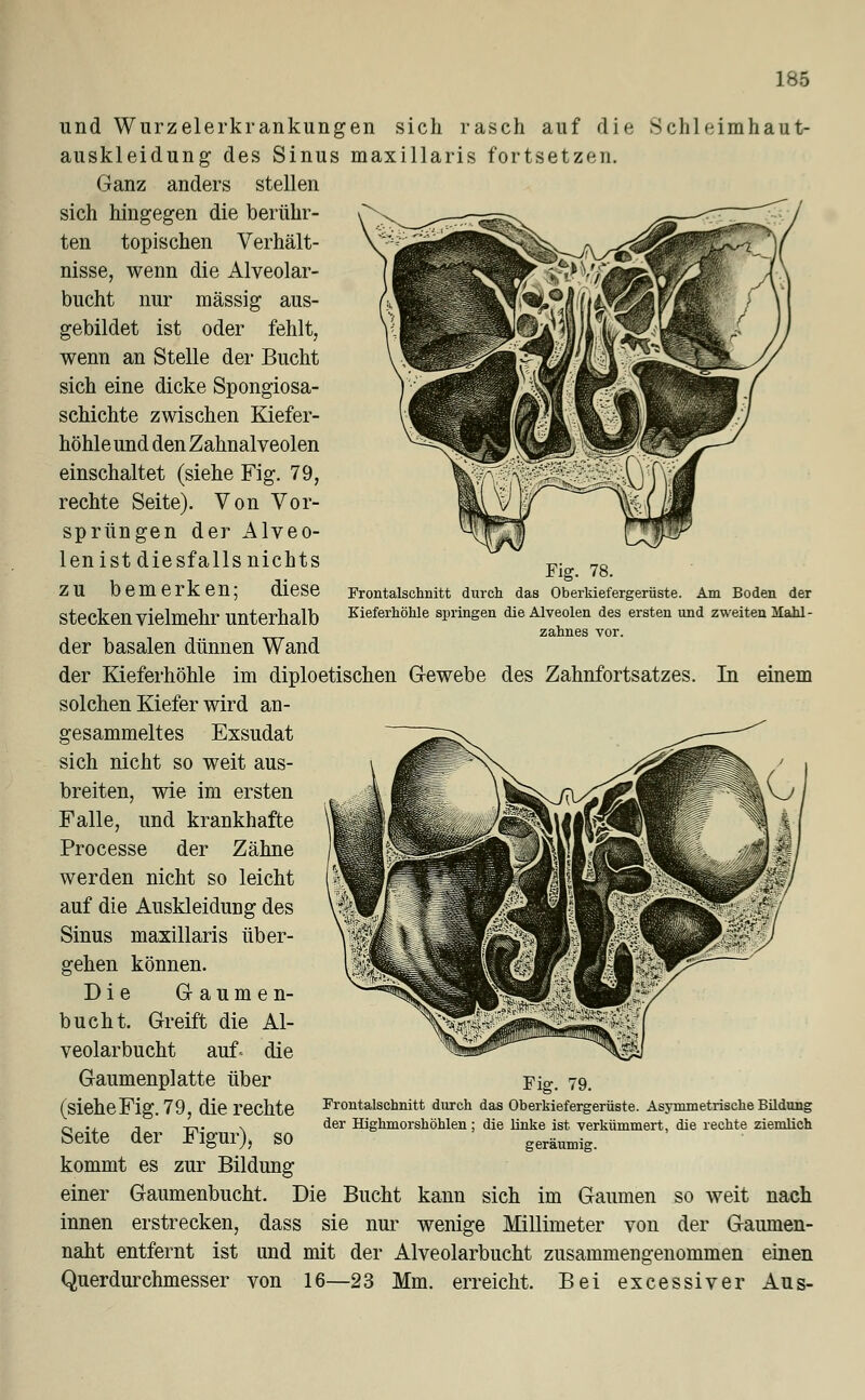 ]85 Fig. 78. Frontalschnitt durch das Oberkiefergerüste. Am Boden der Kieferhöhle springen die Alveolen des ersten und zweiten Mahl - zahnes vor. In einem und Wurzelerkrankungen sich rasch auf die Schleimhaut- auskleidung des Sinus maxillaris fortsetzen. Ganz anders stellen sich hingegen die berühr- ten topischen Verhält- nisse, wenn die Alveolar- bucht nur massig aus- gebildet ist oder fehlt, wenn an Stelle der Bucht sich eine dicke Spongiosa- schichte zwischen Kiefer- höhle und den Zahnalveolen einschaltet (siehe Fig. 79, rechte Seite). Von Vor- sprüngen der Alveo- len ist diesfalls nichts zu bemerken; diese stecken vielmehr unterhalb der basalen dünnen Wand der Kieferhöhle im diploetischen Gewebe des Zahnfortsatzes solchen Kiefer wird an- gesammeltes Exsudat sich nicht so weit aus- breiten, wie im ersten Falle, und krankhafte Processe der Zähne werden nicht so leicht auf die Auskleidung des Sinus maxillaris über- gehen können. Die Gaumen- bucht. Greift die Al- veolarbucht auf- die Gaumenplatte über (sieheFig. 79, die rechte Seite der Figur), so kommt es zur Bildung einer Gaumenbucht. Die Bucht kann sich im Gaumen so weit nach innen erstrecken, dass sie nur wenige Millimeter von der Gaumen- naht entfernt ist und mit der Alveolarbucht zusammengenommen einen Querdurchmesser von 16—23 Mm. erreicht. Bei excessiver Aus- Fig. 79. Frontalschnitt durch das Oberkiefergerüste. Asymmetrische Bildung der Highmorshöhlen; die linke ist verkümmert, die rechte ziemlich geräumig.