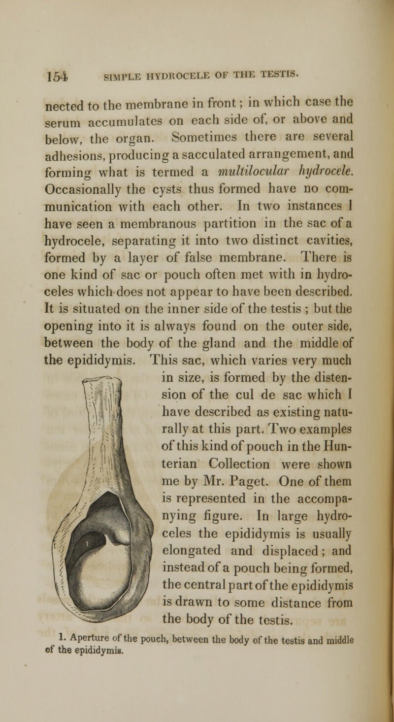 nected to the membrane in front; in which case the serum accumulates on each side of, or above and below, the organ. Sometimes there are several adhesions, producing a sacculated arrangement, and forming what is termed a multilocular hydrocele. Occasionally the cysts thus formed have no com- munication with each other. In two instances I have seen a membranous partition in the sac of a hydrocele, separating it into two distinct cavities, formed by a layer of false membrane. There is one kind of sac or pouch often met with in hydro- celes which does not appear to have been described. It is situated on the inner side of the testis ; but the opening into it is always found on the outer side, between the body of the gland and the middle of the epididymis. This sac, which varies very much in size, is formed by the disten- sion of the cul de sac which I have described as existing natu- rally at this part. Two examples of this kind of pouch in the Hun- terian Collection were shown me by Mr. Paget. One of them is represented in the accompa- nying figure. In large hydro- celes the epididymis is usually elongated and displaced; and instead of a pouch being formed, the central part of the epididymis is drawn to some distance from the body of the testis. 1. Aperture of the pouch, between the body of the testis and middle of the epididymis.