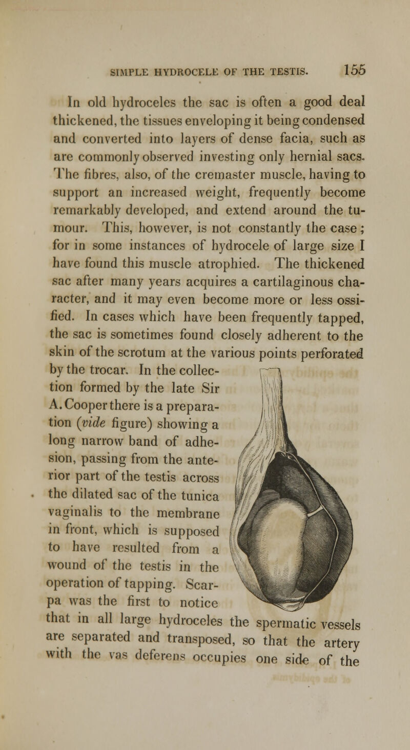 In old hydroceles the sac is often a good deal thickened, the tissues enveloping it being condensed and converted into layers of dense facia, such as are commonly observed investing only hernial sacs. The fibres, also, of the cremaster muscle, having to support an increased weight, frequently become remarkably developed, and extend around the tu- mour. This, however, is not constantly the case; for in some instances of hydrocele of large size I have found this muscle atrophied. The thickened sac after many years acquires a cartilaginous cha- racter, and it may even become more or less ossi- fied. In cases which have been frequently tapped, the sac is sometimes found closely adherent to the skin of the scrotum at the various points perforated by the trocar. In the collec- tion formed by the late Sir A. Cooper there is a prepara- tion (vide figure) showing a long narrow band of adhe- sion, passing from the ante- rior part of the testis across the dilated sac of the tunica vaginalis to the membrane in front, which is supposed to have resulted from a wound of the testis in the operation of tapping. Scar- pa was the first to notice that in all large hydroceles the spermatic vessels are separated and transposed, so that the artery with the vas deferens occupies one side of the