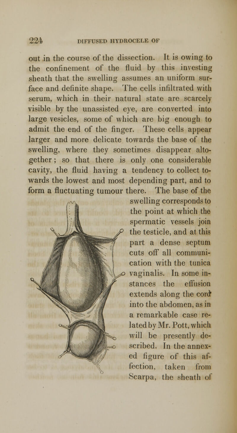 out in the course of the dissection. It is owing to the confinement of the fluid by this investing sheath that the swelling assumes an uniform sur- face and definite shape. The cells infiltrated with serum, which in their natural state are scarcely visible by the unassisted eye, are converted into large vesicles, some of which are big enough to admit the end of the finger. These cells appear larger and more delicate towards the base of the swelling, where they sometimes disappear alto- gether ; so that there is only one considerable cavity, the fluid having a tendency to collect to- wards the lowest and most depending part, and to form a fluctuating tumour there. The base of the swelling corresponds to the point at which the spermatic vessels join the testicle, and at this part a dense septum cuts off all communi- cation with the tunica vaginalis. In some in- stances the effusion extends along the cord* into the abdomen, as in a remarkable case re- lated by Mr. Pott, which will be presently de- scribed. In the annex- ed figure of this af- fection, taken from Scarpa, the sheath of