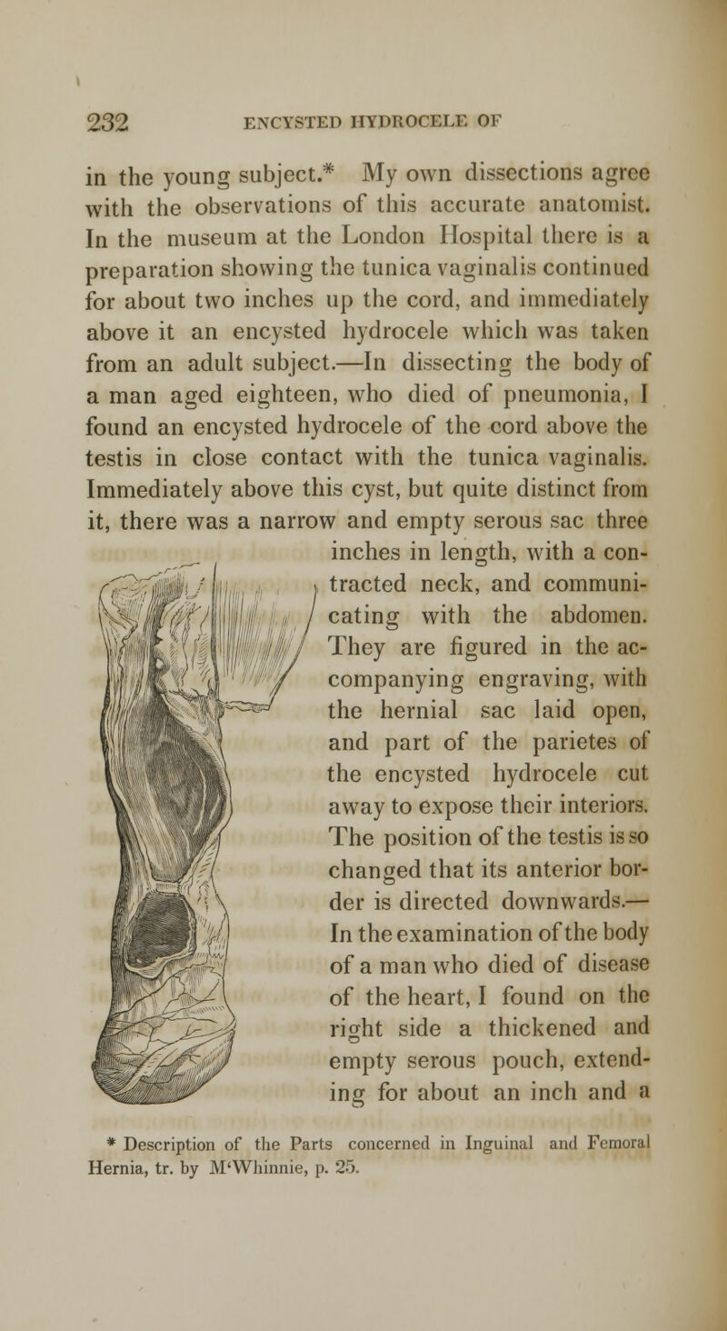 in the young subject.* My own dissections agree with the observations of this accurate anatomist. In the museum at the London Hospital there is a preparation showing the tunica vaginalis continued for about two inches up the cord, and immediately above it an encysted hydrocele which was taken from an adult subject.—In dissecting the body of a man aged eighteen, who died of pneumonia, I found an encysted hydrocele of the cord above the testis in close contact with the tunica vaginalis. Immediately above this cyst, but quite distinct from it, there was a narrow and empty serous sac three inches in length, with a con- tracted neck, and communi- cating with the abdomen. They are figured in the ac- companying engraving, with the hernial sac laid open, and part of the parietes of the encysted hydrocele cut away to expose their interiors. The position of the testis is so changed that its anterior bor- der is directed downwards.— In the examination of the body of a man who died of disease of the heart, I found on the right side a thickened and empty serous pouch, extend- ing for about an inch and a * Description of the Parts concerned in Inguinal and Femoral Hernia, tr. by M'Whinnie, p. 25.