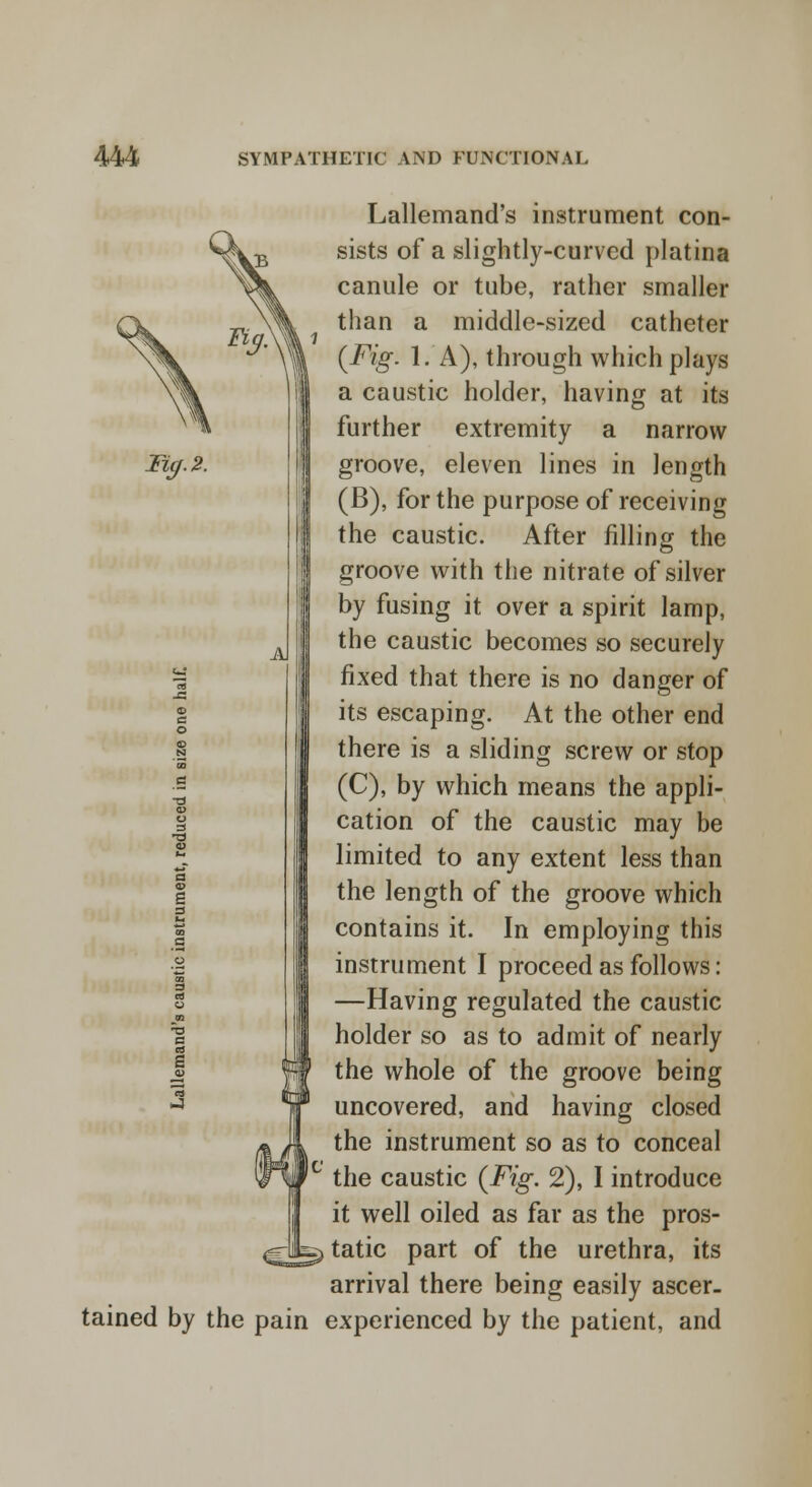 FiS. Tig. 2. A Lallemand's instrument con- sists of a slightly-curved platina canule or tube, rather smaller than a middle-sized catheter (Fig. 1. A), through which plays a caustic holder, having at its further extremity a narrow groove, eleven lines in length (B), for the purpose of receiving the caustic. After filling the groove with the nitrate of silver by fusing it over a spirit lamp, the caustic becomes so securely fixed that there is no danger of its escaping. At the other end there is a sliding screw or stop (C), by which means the appli- cation of the caustic may be limited to any extent less than the length of the groove which contains it. In employing this instrument I proceed as follows: —Having regulated the caustic holder so as to admit of nearly the whole of the groove being uncovered, and having closed the instrument so as to conceal the caustic (Fig. 2), I introduce it well oiled as far as the pros- ^ tatic part of the urethra, its arrival there being easily ascer- tained by the pain experienced by the patient, and