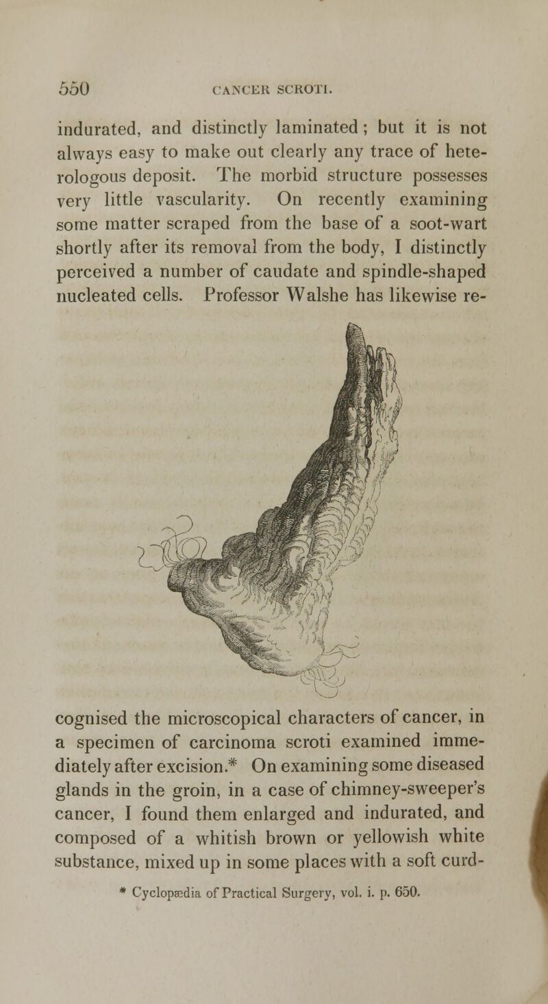 indurated, and distinctly laminated ; but it is not always easy to make out clearly any trace of hete- rologous deposit. The morbid structure possesses very little vascularity. On recently examining some matter scraped from the base of a soot-wart shortly after its removal from the body, I distinctly perceived a number of caudate and spindle-shaped nucleated cells. Professor Walshe has likewise re- cognised the microscopical characters of cancer, in a specimen of carcinoma scroti examined imme- diately after excision* On examining some diseased glands in the groin, in a case of chimney-sweeper's cancer, I found them enlarged and indurated, and composed of a whitish brown or yellowish white substance, mixed up in some places with a soft curd- * Cyclopaedia of Practical Surgery, vol. i. p. 650.