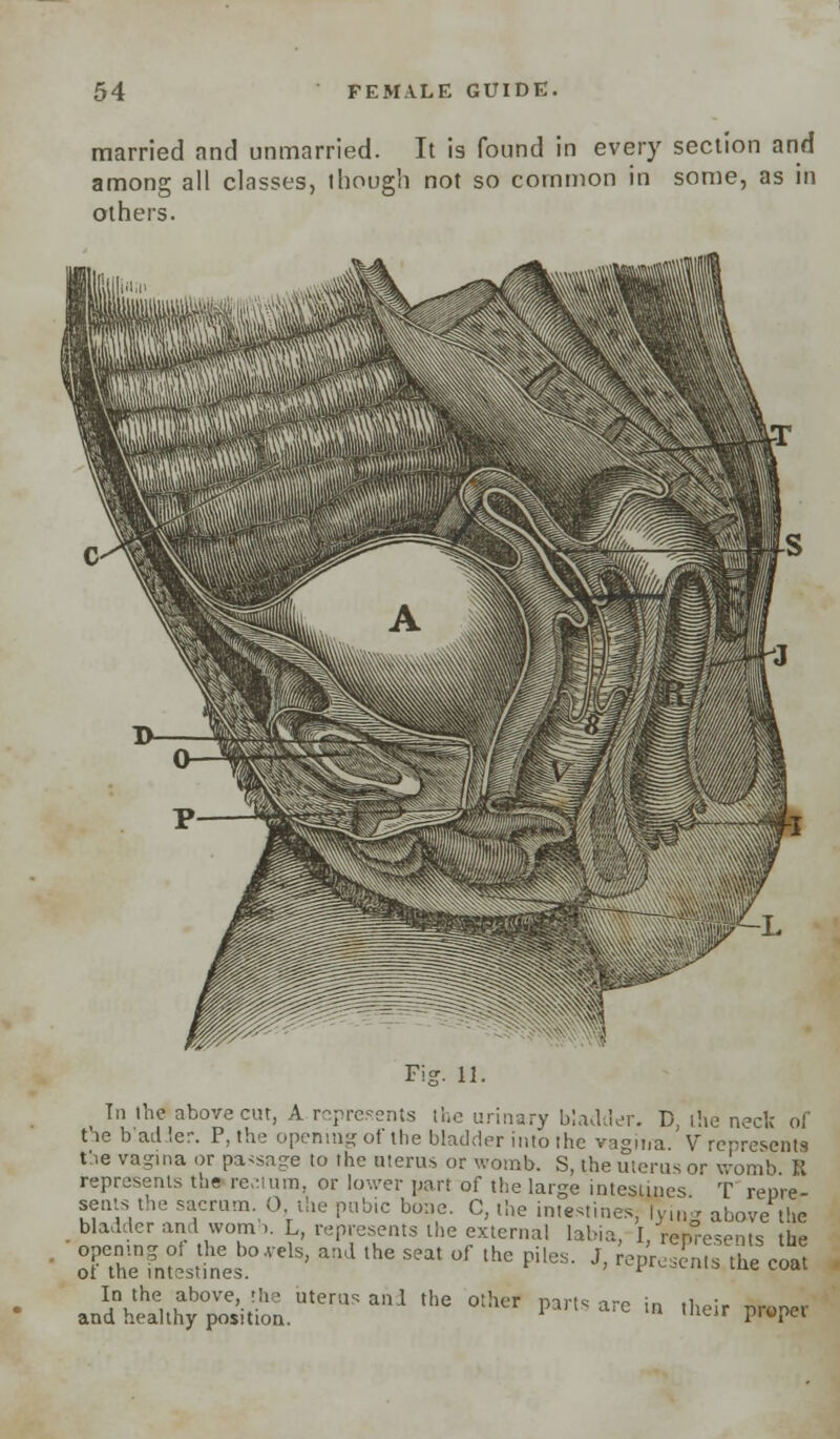 married and unmarried. It is found in every section and among all classes, though not so common in some, as in others. Fig. 11. t In the above cut, A represents the urinary bladder. B, ihe neck of the bladder. P, the opening of the bladder into the vagina. V represents the vagina or passage to the uterus or womb. S, the uterus or womb S represents the re.uum, or lower part of the large intestines T repre- sents the sacrum. 0, the pubic bone. C, the intestines, |y,„', above the bladder and womb. L, represents the external labia, I, represents the oTthenfntLlinee!,OVelS' a:1   °f ,hc pi,es- J< ^F--nfs the coat Jl&SS&ZJ**™9* thG °!hCr Pamare - -ir proper