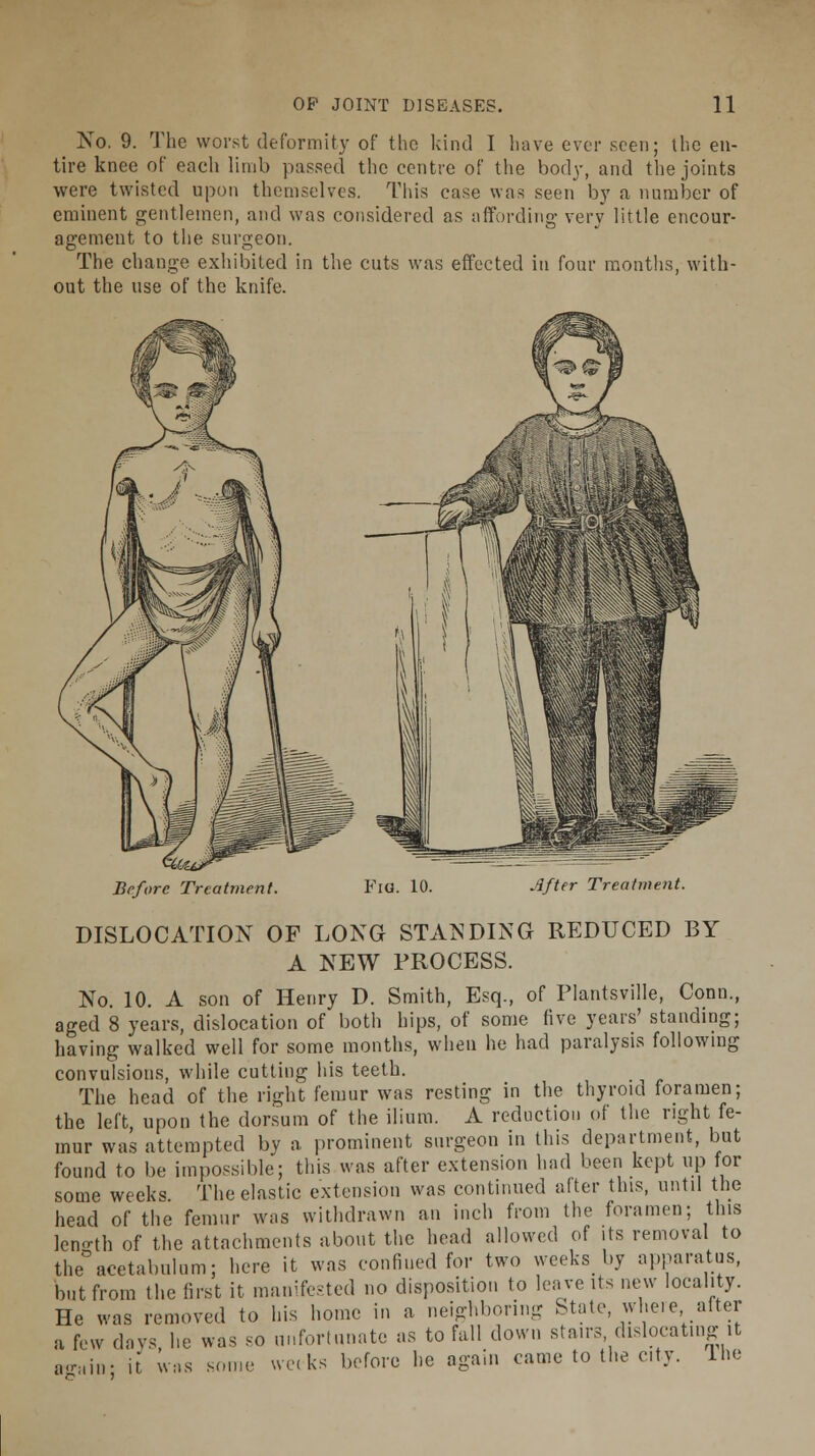 No. 9. The worst deformity of the kind I have ever seen; the en- tire knee of each limb passed the centre of the body, and the joints were twisted upon themselves. This ease was seen by a number of eminent gentlemen, and was considered as affording very little encour- agement to the surgeon. The change exhibited in the cuts was effected in four months, with- out the use of the knife. Before Treatment. Fig. 10. After Treatment. DISLOCATION OF LONG STANDING REDUCED BY A NEW PROCESS. No. 10. A son of Henry D. Smith, Esq., of Plantsville, Conn., aged 8 years, dislocation of both hips, of some five years' standing; having walked well for some months, when he had paralysis following convulsions, while cutting his teeth. The head of the right femur was resting in the thyroid foramen; the left, upon the dorsum of the ilium. A reduction of the right fe- mur was attempted by a prominent surgeon in this department, but found to be impossible; this was after extension had been kept up for some weeks The elastic extension was continued after this, until the head of the femur was withdrawn an inch from the foramen; this leno-th of the attachments about the head allowed of its removal to the acetabulum; here it was confined for two weeks by apparatus, but from the first it manifested no disposition to leave its n^v locality. He was removed to his home in a neighboring State, where, after a few days he was so unfortunate as to fall down stairs dislocating it atraiiv it was some weeks before he again came to the city, lne
