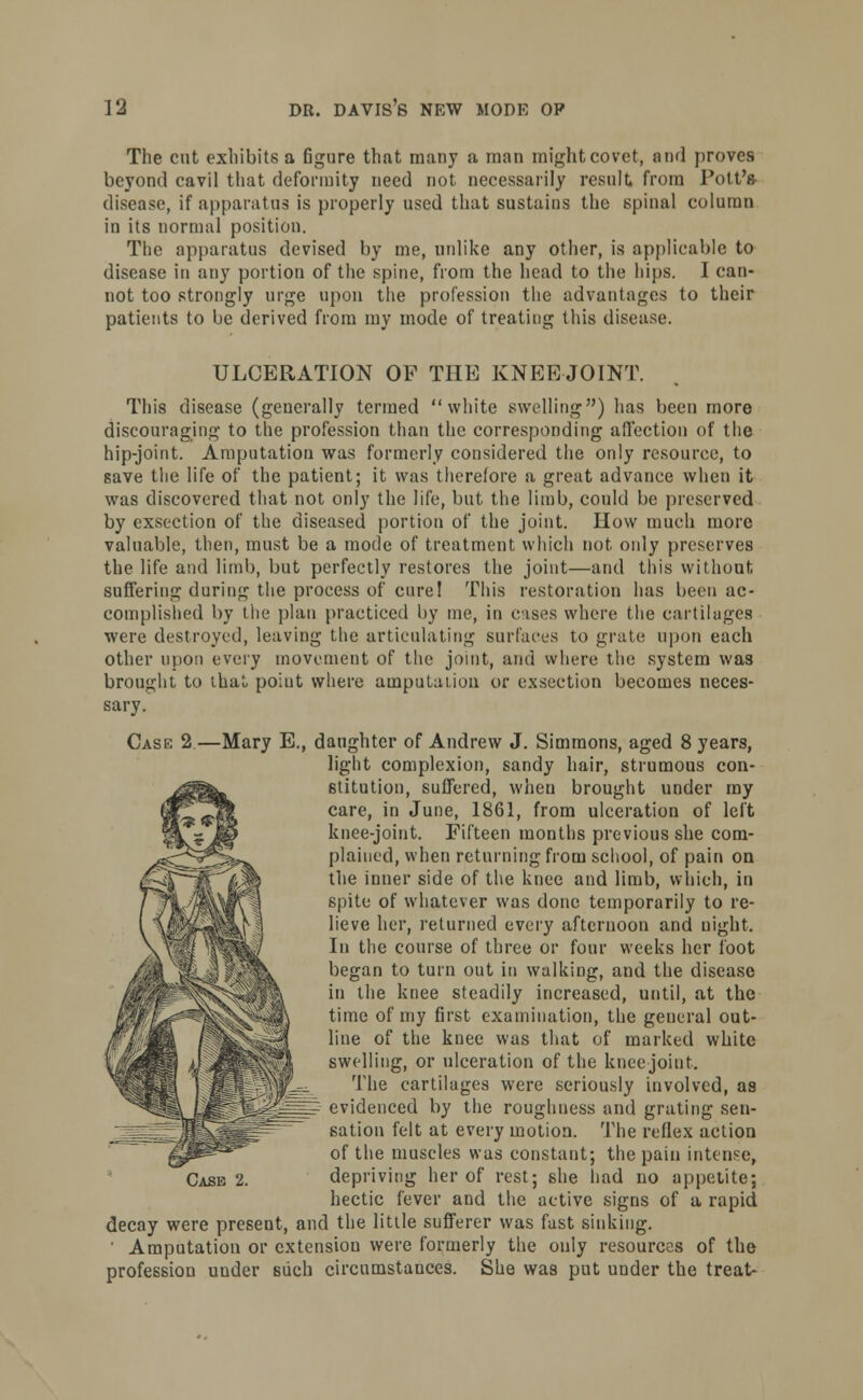 The cut exhibits a figure that many a man might covet, and proves beyond cavil that deformity need not necessarily result from Pott's disease, if apparatus is properly used that sustains the spinal column in its normal position. The apparatus devised by me, unlike any other, is applicable to disease in any portion of the spine, from the head to the hips. I can- not too strongly urge upon the profession the advantages to their patients to be derived from my mode of treating this disease. ULCERATION OF THE KNEE JOINT. This disease (generally termed white swelling) has been more discouraging to the profession than the corresponding affection of the hip-joint. Amputation was formerly considered the only resource, to save the life of the patient; it was therefore a great advance when it was discovered that not only the life, but the limb, could be preserved by exsection of the diseased portion of the joint. How much more valuable, then, must be a mode of treatment which not only preserves the life and limb, but perfectly restores the joint—and this without suffering daring the process of cure! This restoration has been ac- complished by the plan practiced by me, in cases where the cartilages were destroyed, leaving the articulating surfaces to grate upon each other upon every movement of the joint, and where the system was brought to that poiut where amputaiiou or exsection becomes neces- sary. Case 2—Mary E., daughter of Andrew J. Simmons, aged 8 years, light complexion, sandy hair, strumous con- stitution, suffered, when brought under my care, in June, 1861, from ulceration of left knee-joint. Fifteen months previous she com- plained, when returning from school, of pain on the inner side of the knee and limb, which, in spite of whatever was done temporarily to re- lieve her, returned every afternoon and night. In the course of three or four weeks her foot began to turn out in walking, and the disease in the knee steadily increased, until, at the time of my first examination, the general out- line of the knee was that of marked white swelling, or ulceration of the knee joint. The cartilages were seriously involved, as evidenced by the roughness and grating sen- sation felt at every motion. The reflex action of the muscles was constant; the pain intense, hectic fever and the active signs of a rapid decay were present, and the little sufferer was fast sinking. ' Amputation or extension were formerly the ouly resources of the profession under such circumstances. She was put under the treat-