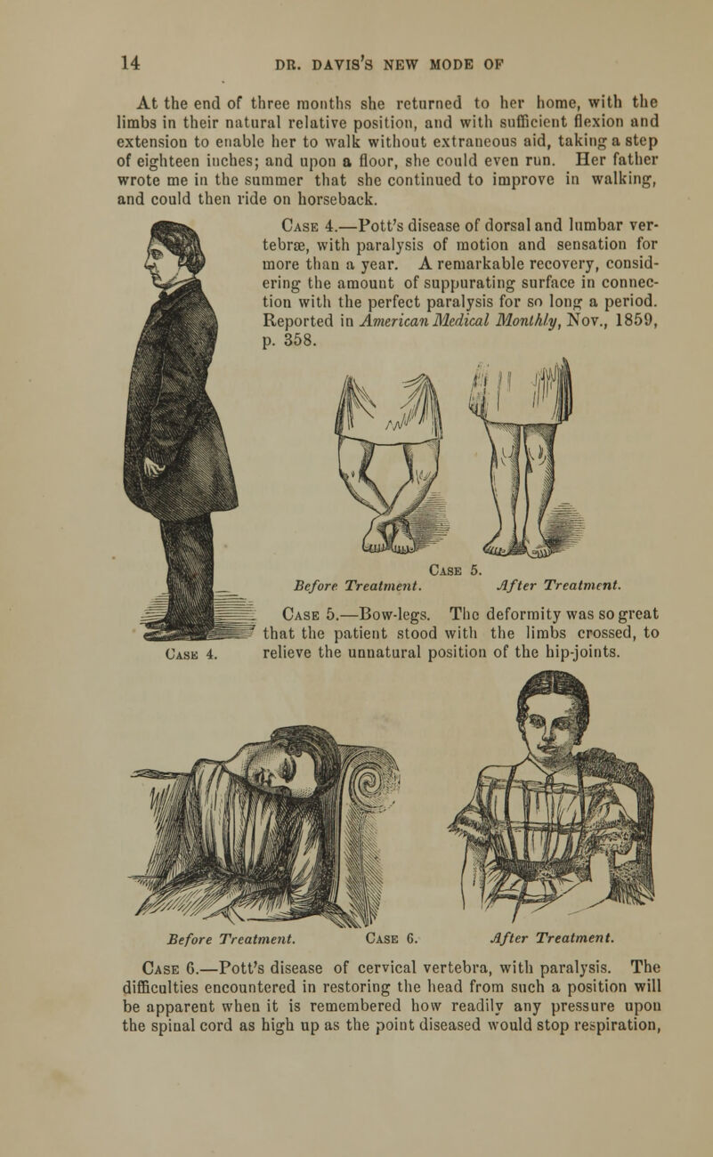 At the end of three months she returned to her home, with the limbs in their natural relative position, and with sufficient flexion and extension to enable her to walk without extraneous aid, taking a step of eighteen inches; and upon a floor, she could even run. Her father wrote me in the summer that she continued to improve in walking, and could then ride on horseback. Case 4.—Pott's disease of dorsal and lumbar ver- tebrae, with paralysis of motion and sensation for more than a year. A remarkable recovery, consid- ering the amount of suppurating surface in connec- tion with the perfect paralysis for so long a period. Reported in American Medical Monthly, Nov., 1859, p. 358. Case 5. Before Treatment. After Treatment. Case 4. Case 5.—Bow-legs. The deformity was so great that the patient stood with the limbs crossed, to relieve the unnatural position of the hip-joints. Before Treatment. 4f Case 6. After Treatment. Case 6.—Pott's disease of cervical vertebra, with paralysis. The difficulties encountered in restoring the head from such a position will be apparent when it is remembered how readily any pressure upon the spinal cord as high up as the point diseased would stop respiration,